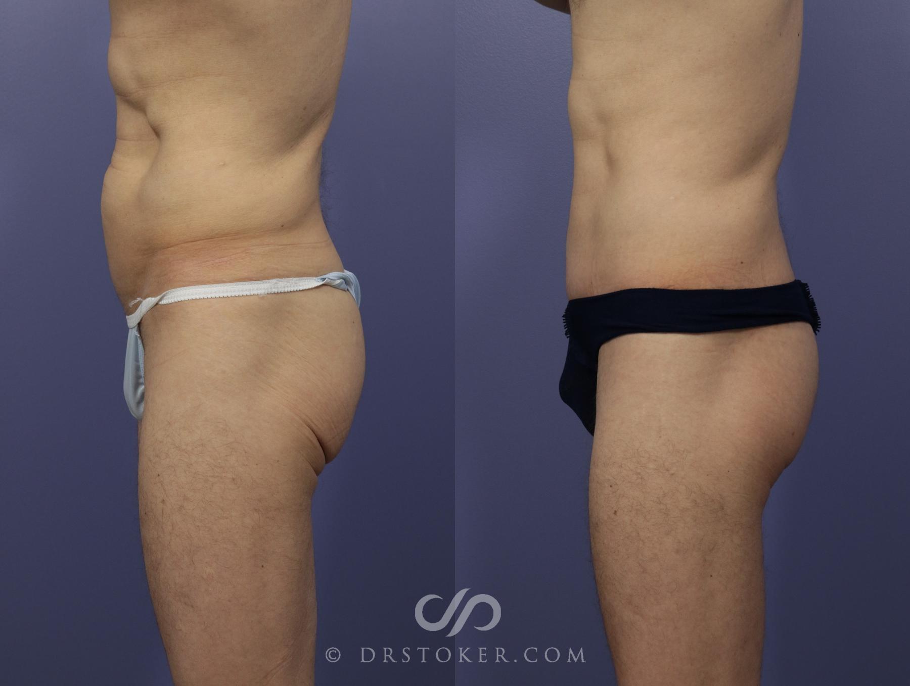 Before & After Body Lift Case 1158 View #4 View in Los Angeles, CA