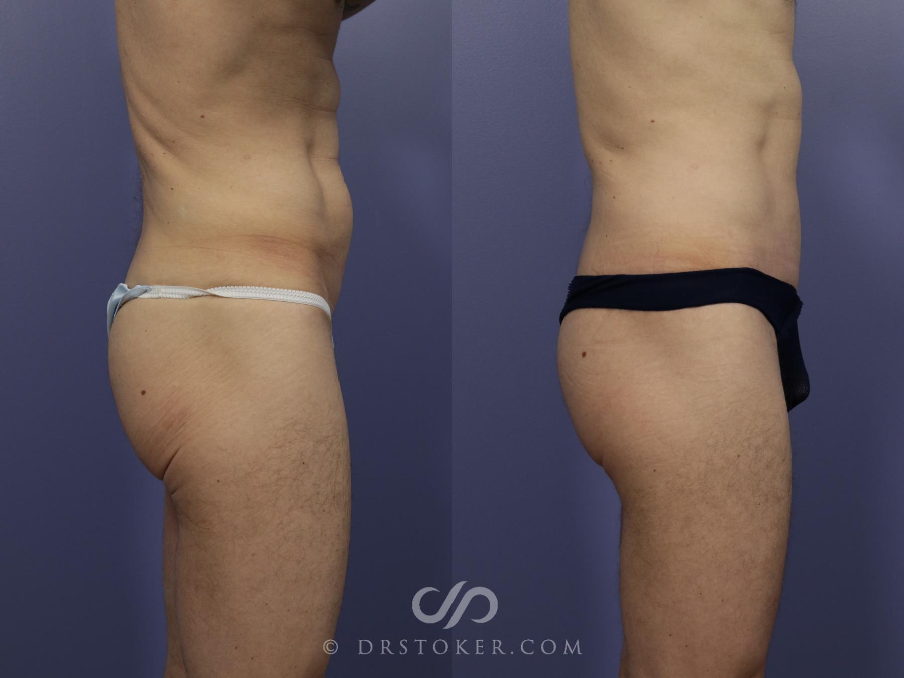 Before & After Body Lift Case 1158 View #5 View in Los Angeles, CA
