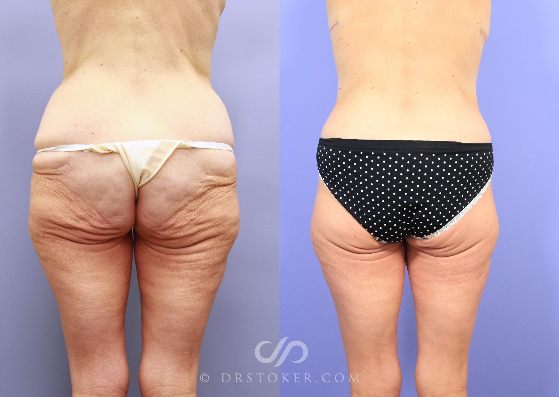 Before & After Body Lift Case 1159 View #1 View in Los Angeles, CA
