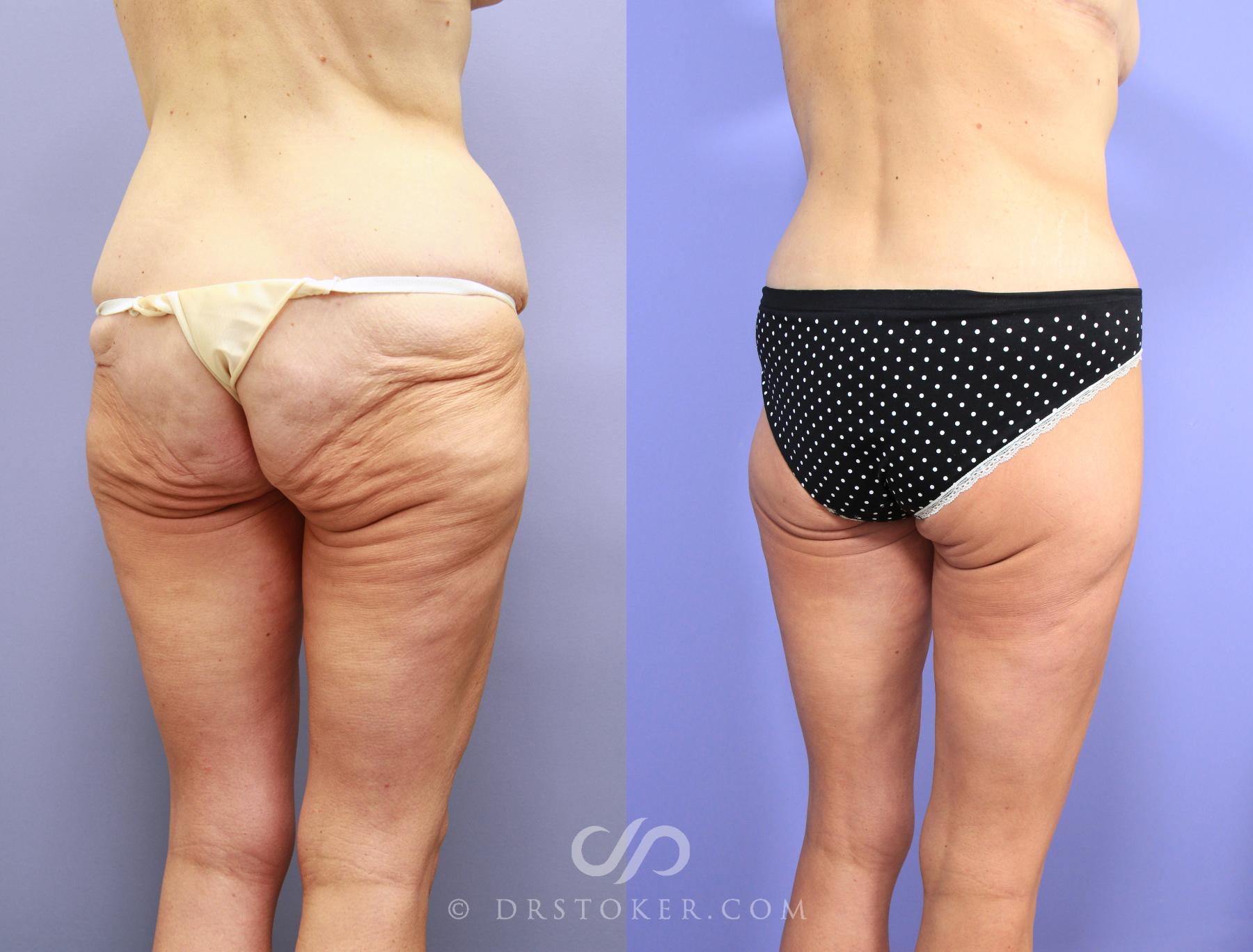 Before & After Body Lift Case 1159 View #2 View in Los Angeles, CA