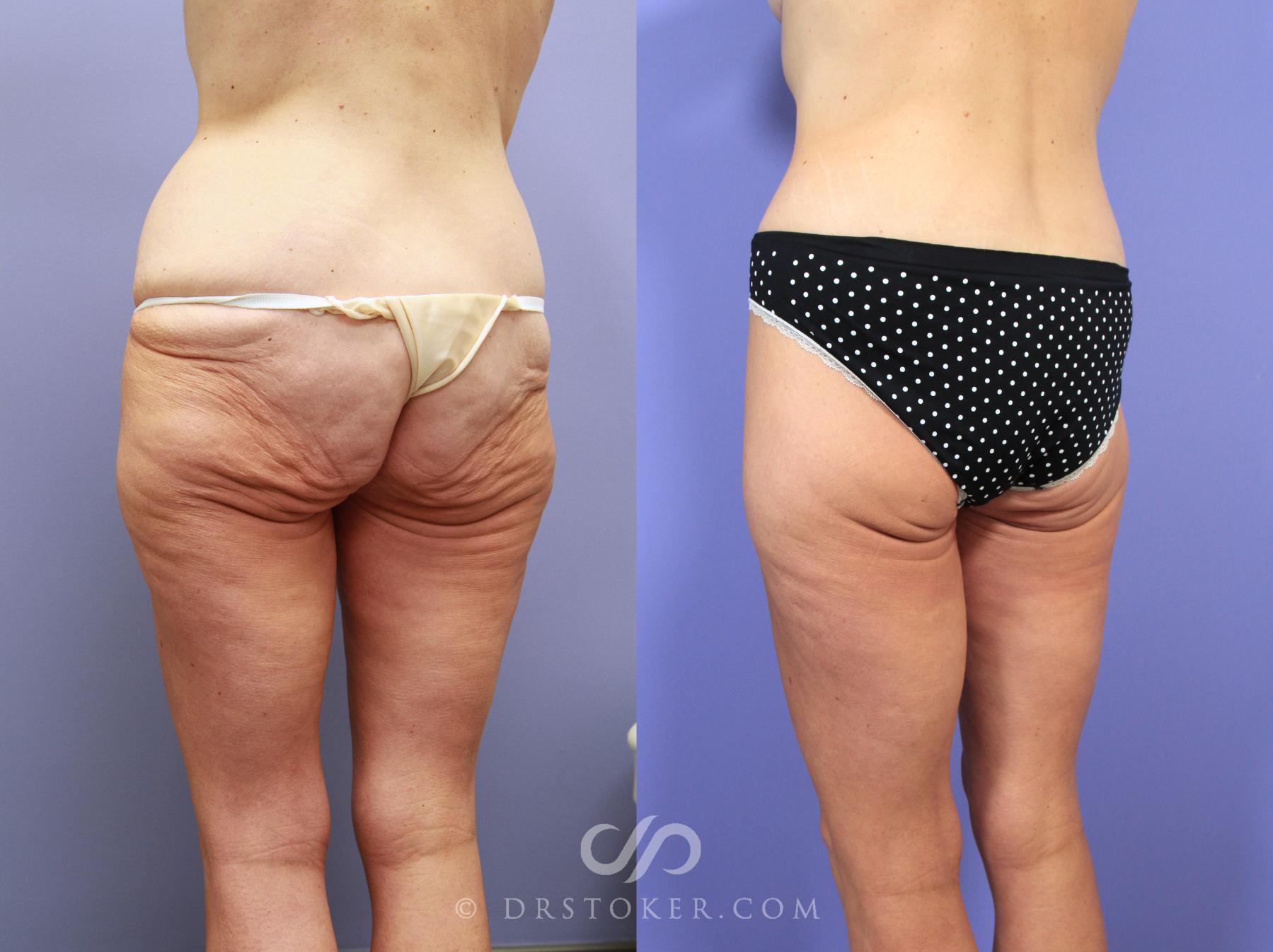 Before & After Body Lift Case 1159 View #3 View in Los Angeles, CA