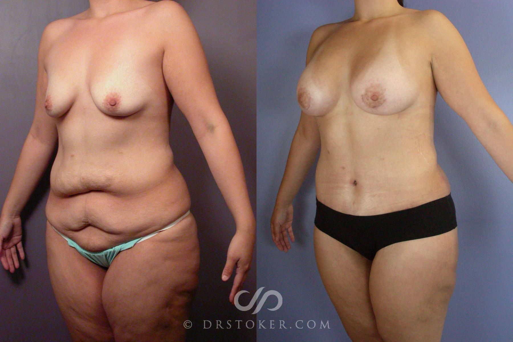 Before & After Body Lift Case 1381 View #1 View in Los Angeles, CA