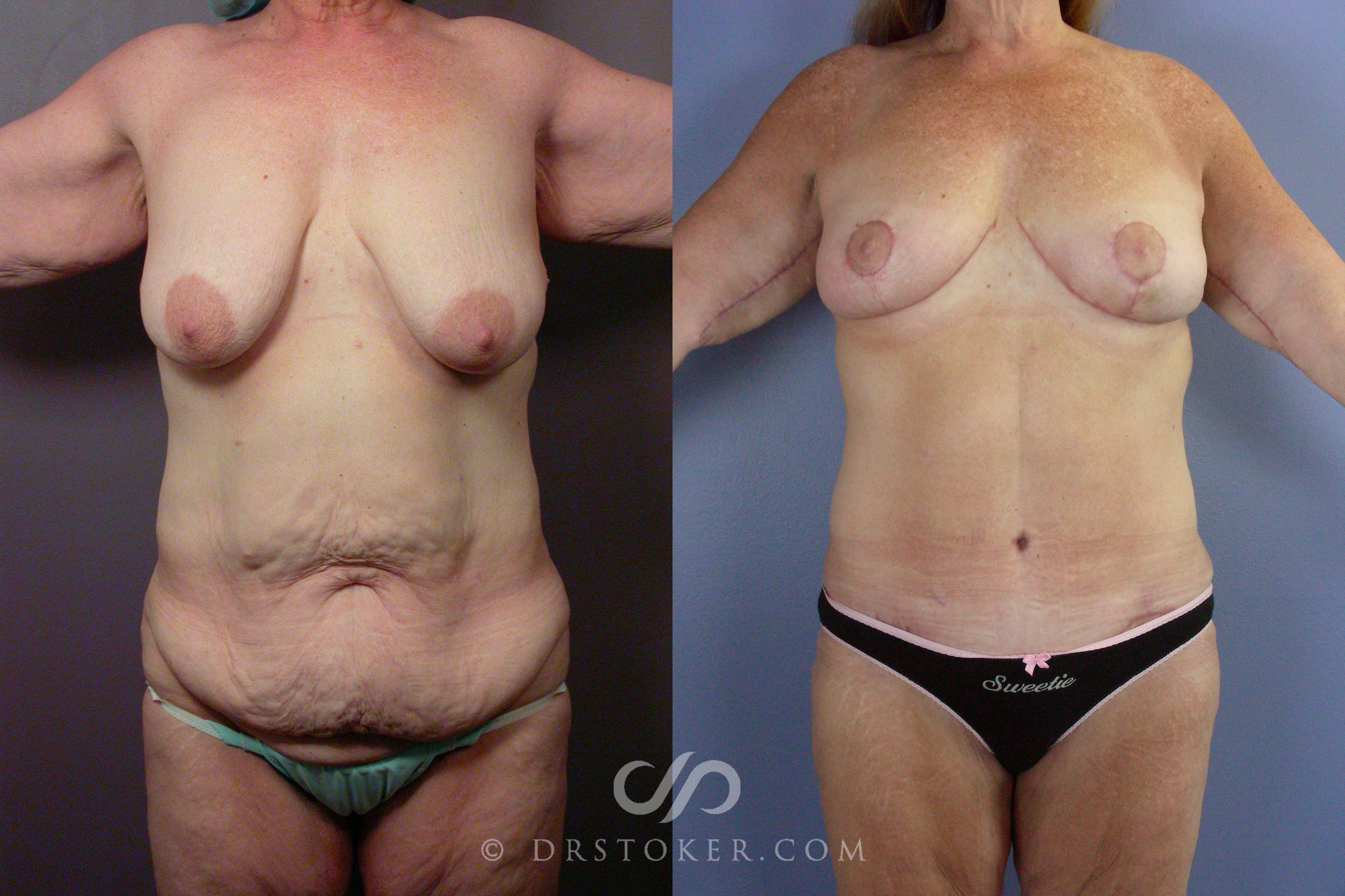 Before & After Body Lift Case 1397 View #1 View in Los Angeles, CA