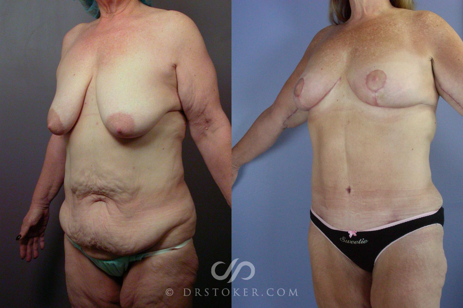 Before & After Body Lift Case 1397 View #2 View in Los Angeles, CA