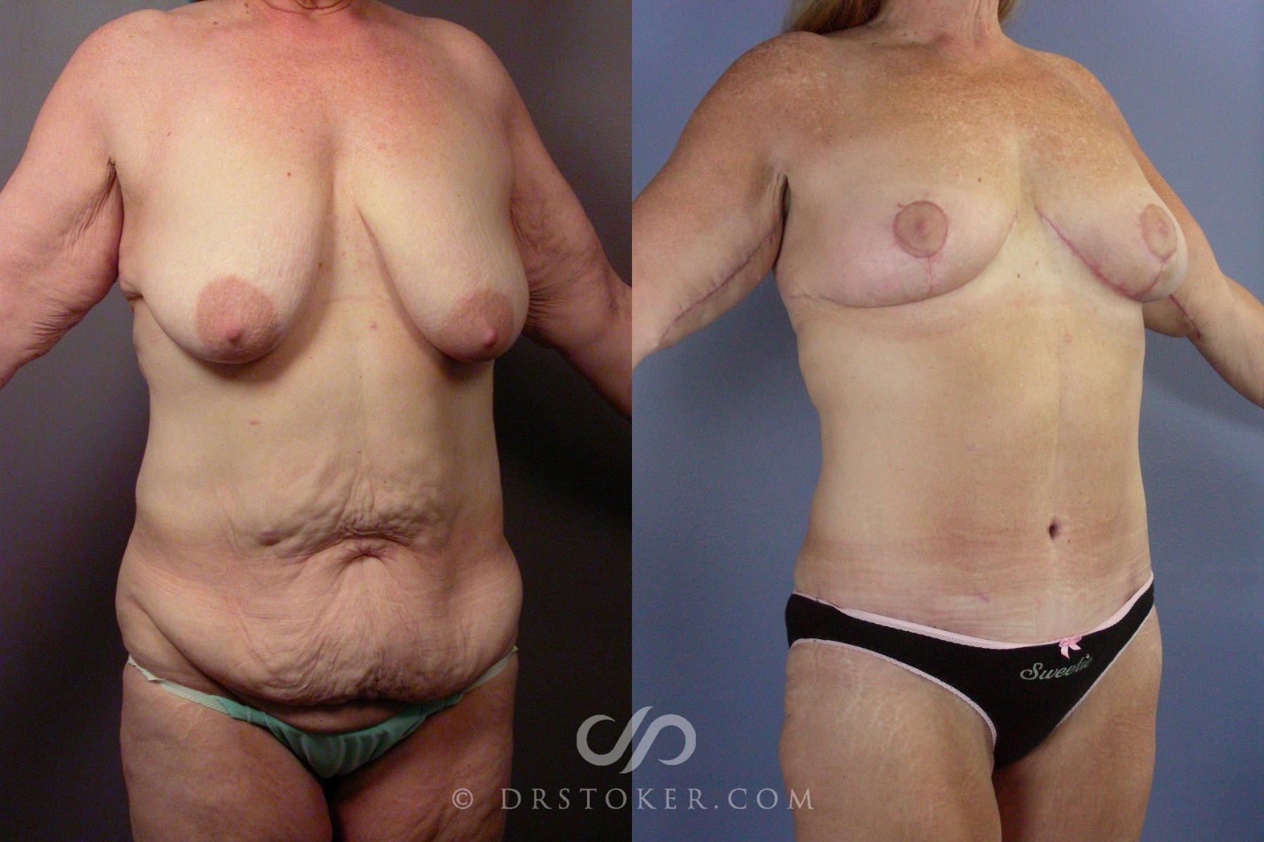 Before & After Body Lift Case 1397 View #3 View in Los Angeles, CA