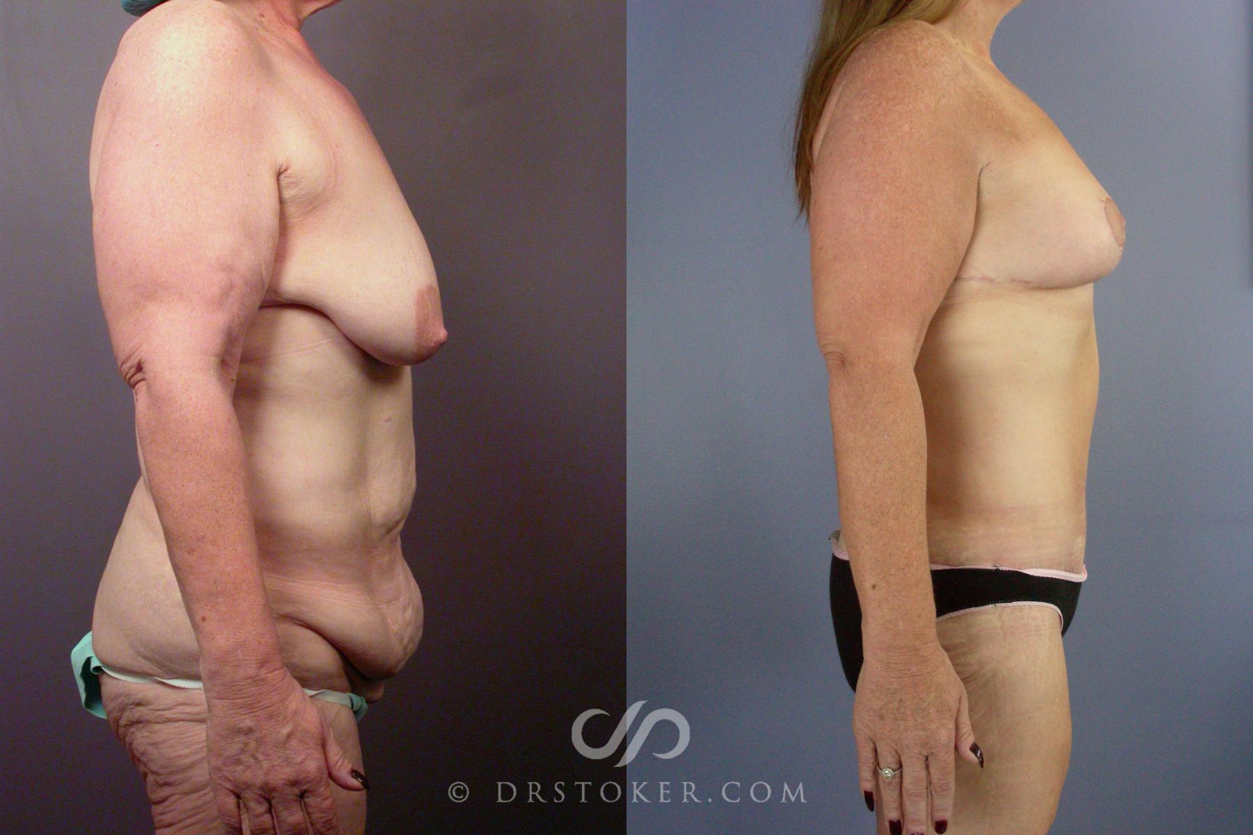 Before & After Body Lift Case 1397 View #4 View in Los Angeles, CA