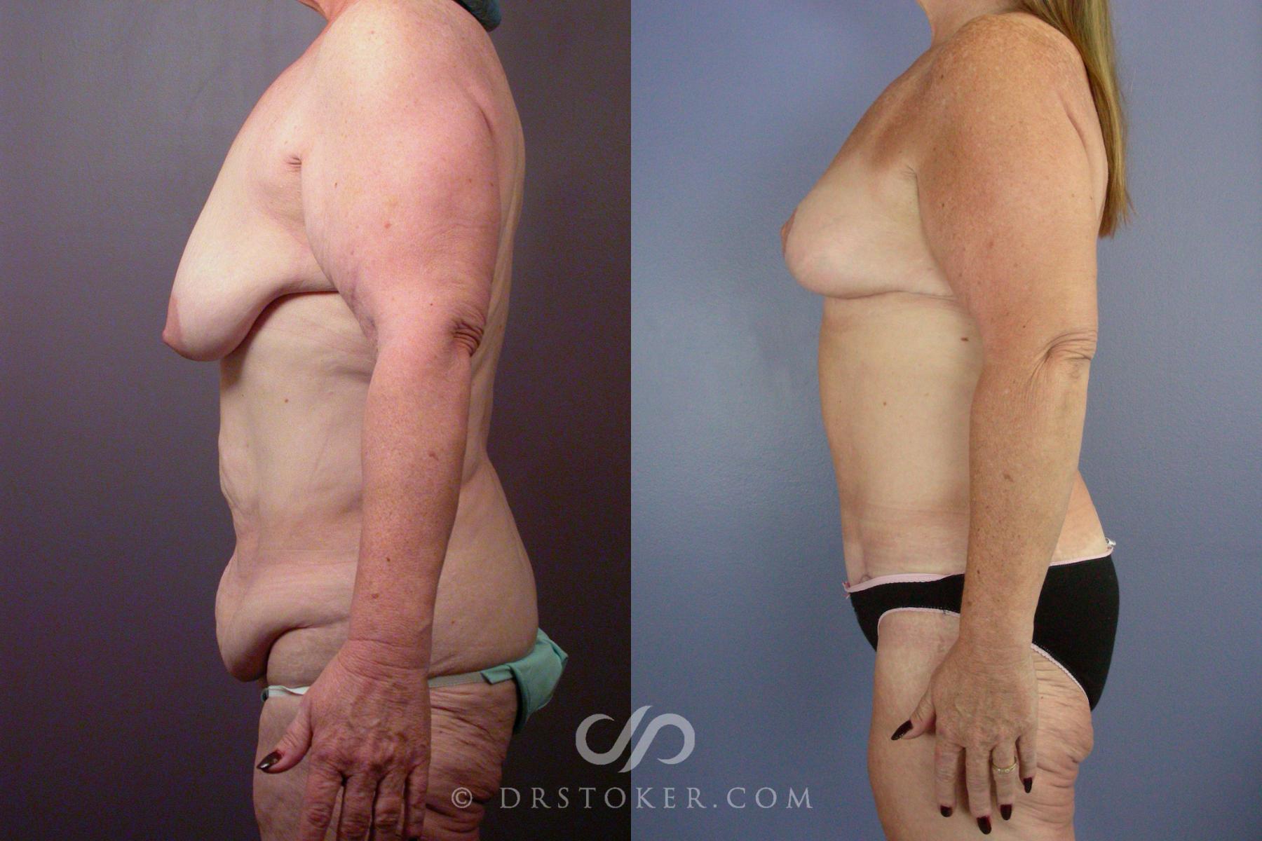 Before & After Body Lift Case 1397 View #5 View in Los Angeles, CA