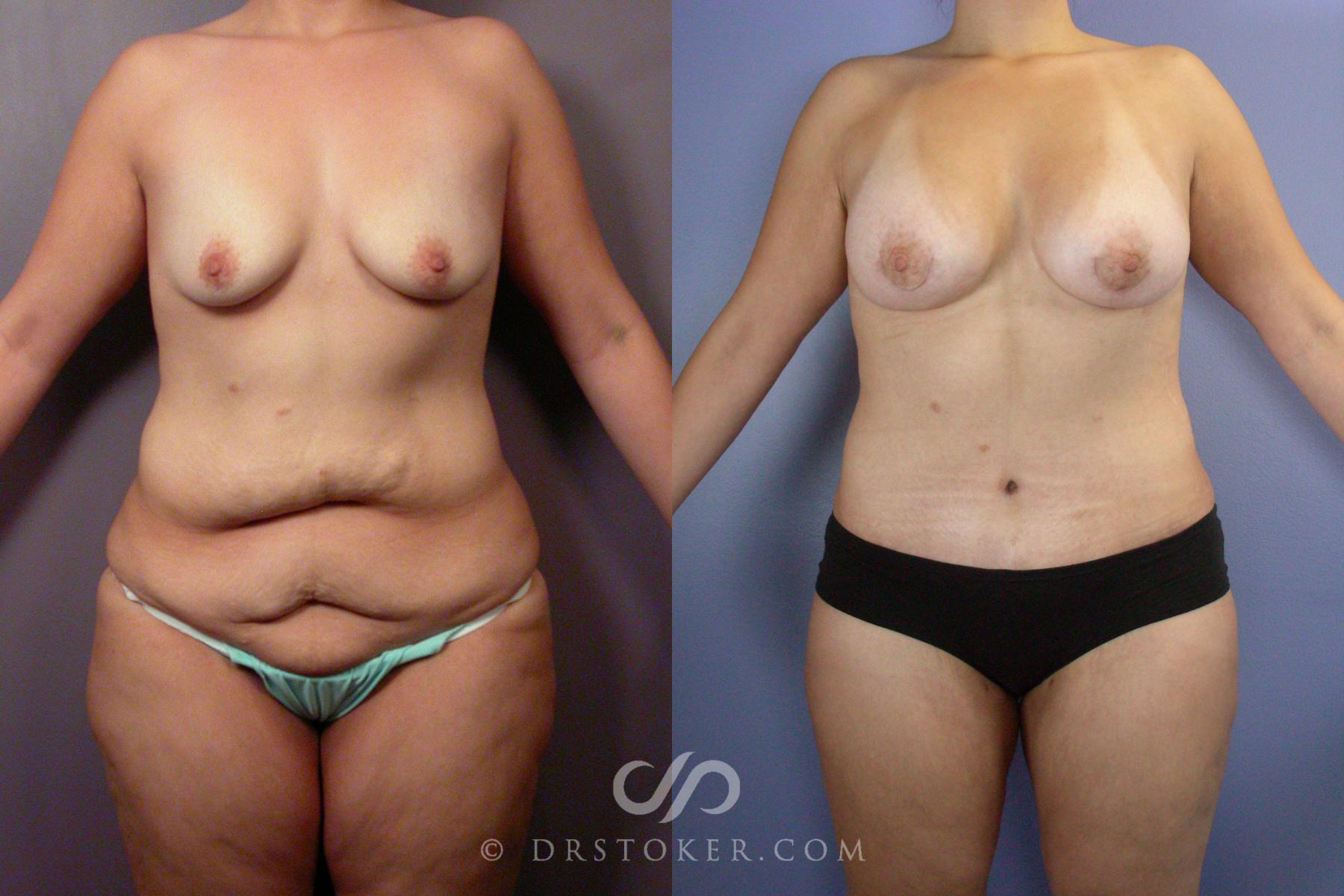 Before & After Body Lift Case 1399 View #1 View in Los Angeles, CA