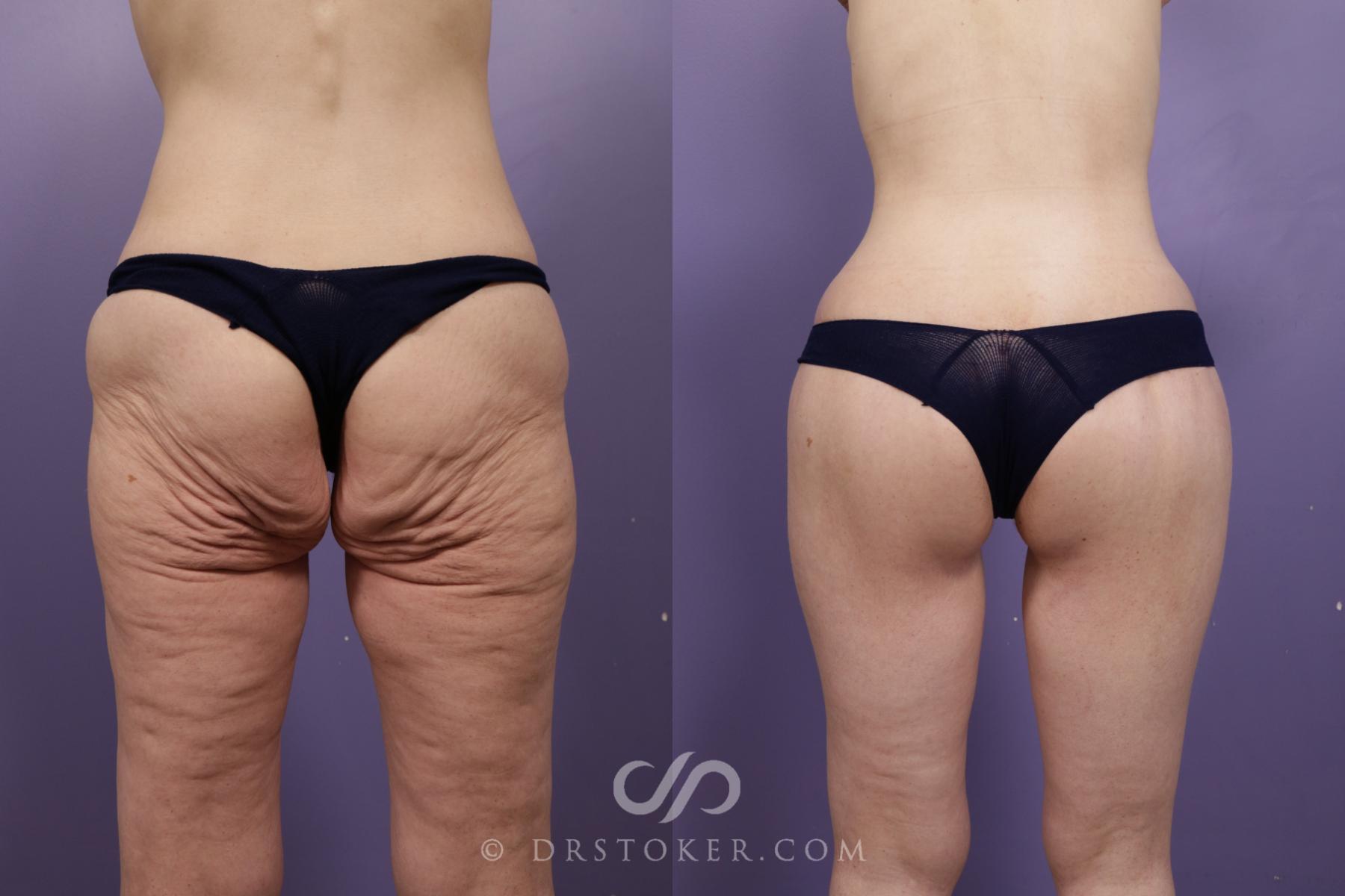 Before & After Body Lift Case 1676 View #1 View in Los Angeles, CA