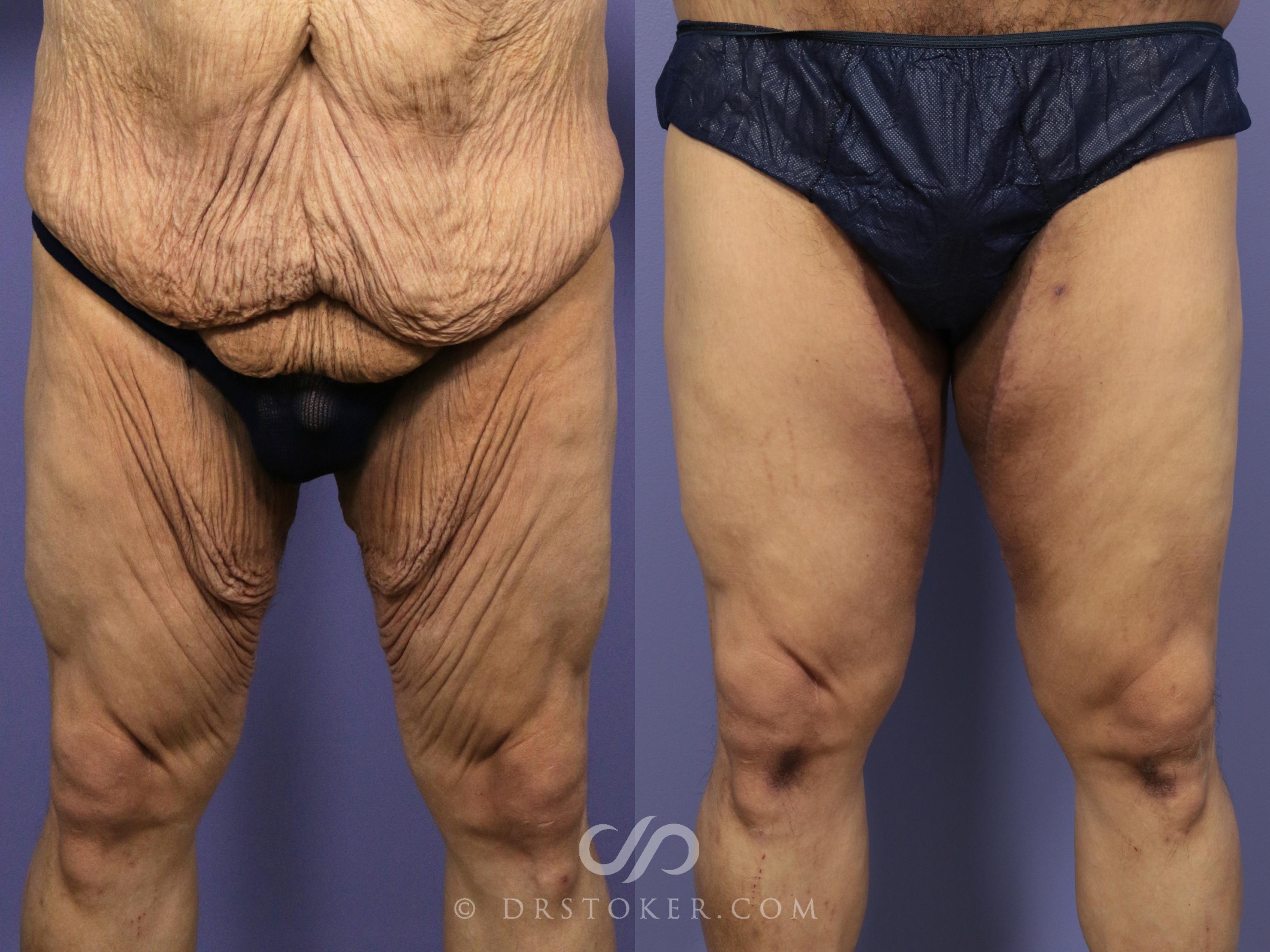 Before & After Body Lift for Men Case 1764 View #1 View in Los Angeles, CA