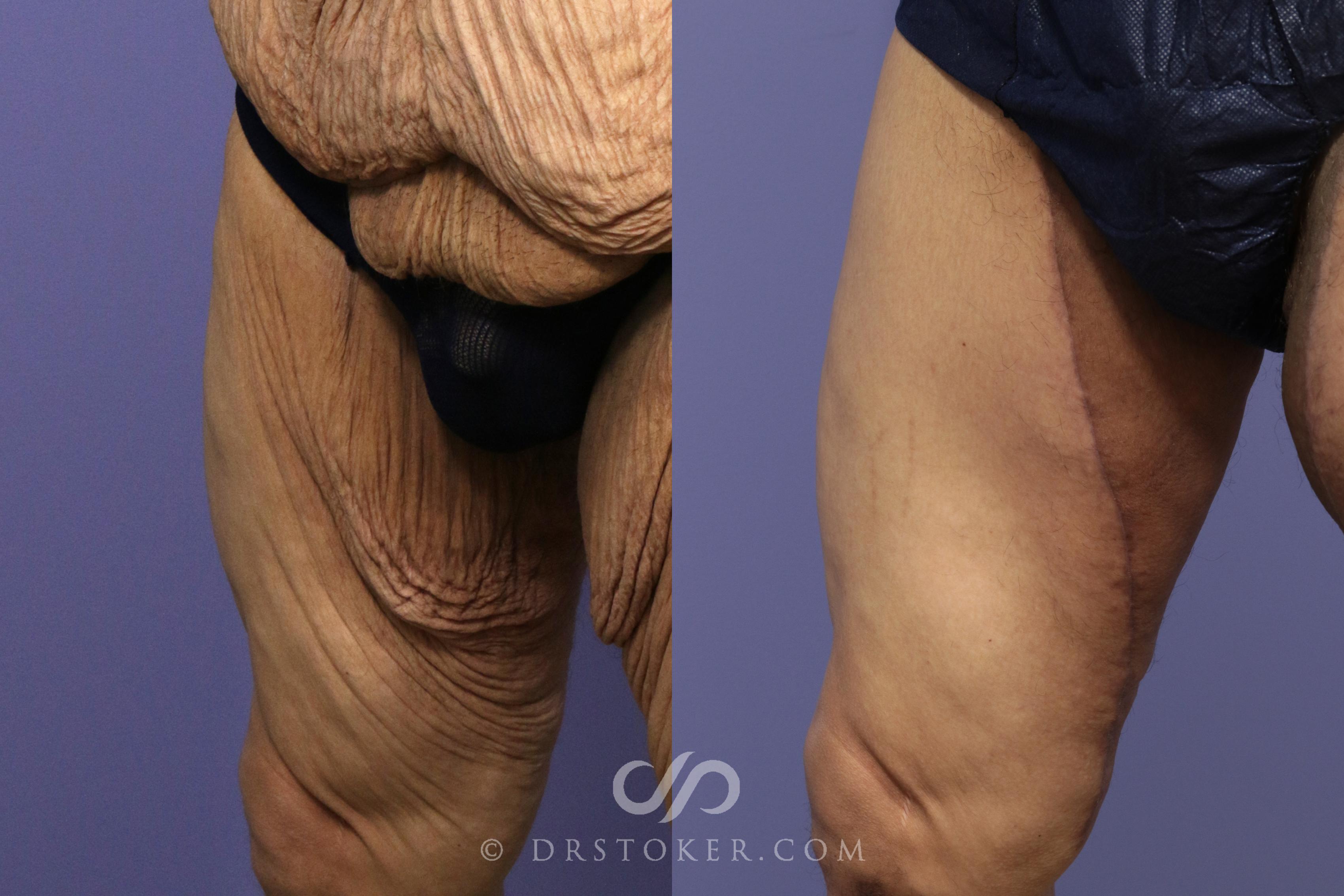 Before & After Body Lift for Men Case 1765 View #1 View in Los Angeles, CA