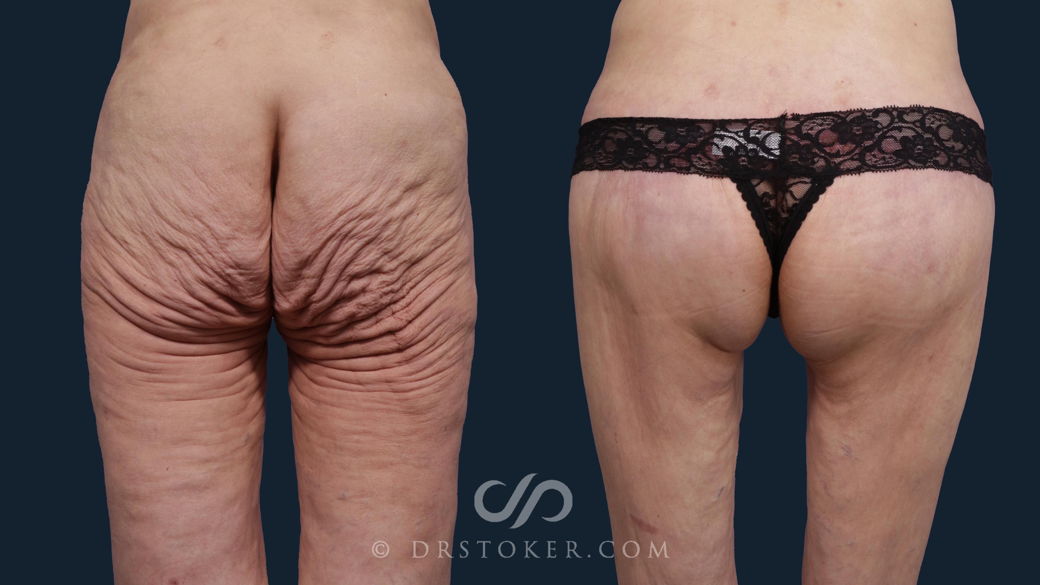 Before & After Body Lift Case 1789 Back View in Los Angeles, CA