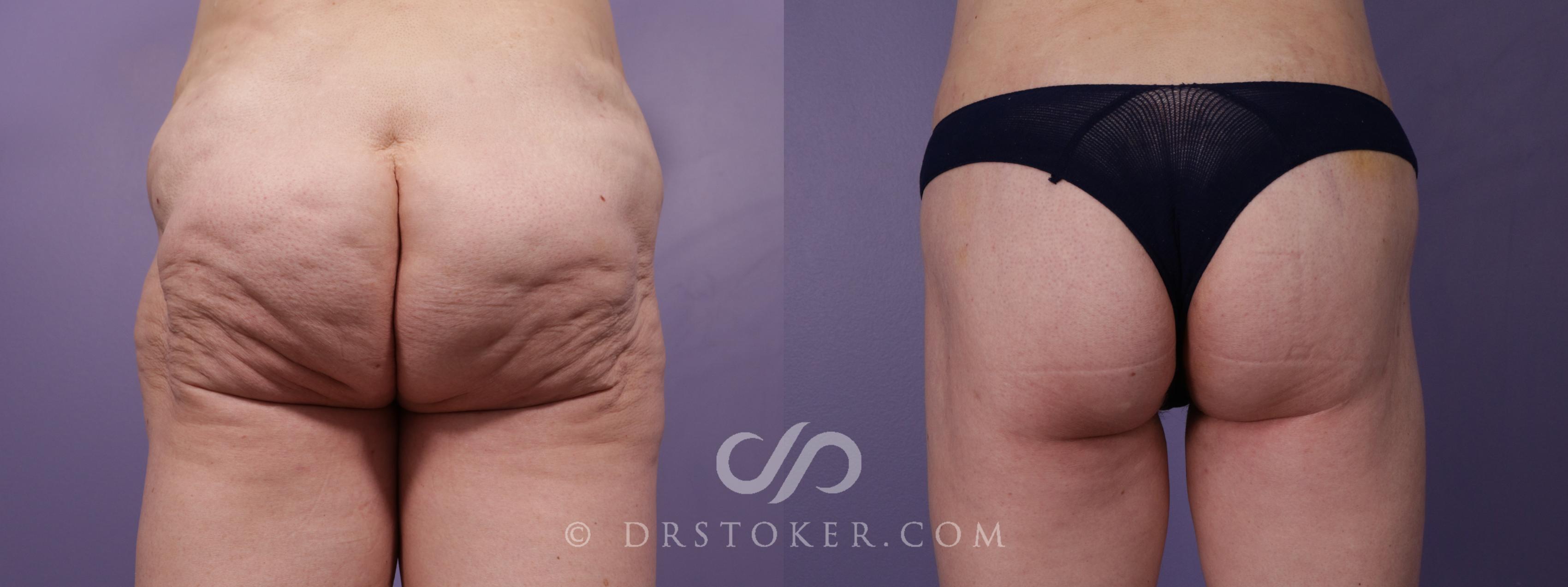 Before & After Body Lift Case 1823 Back View in Los Angeles, CA