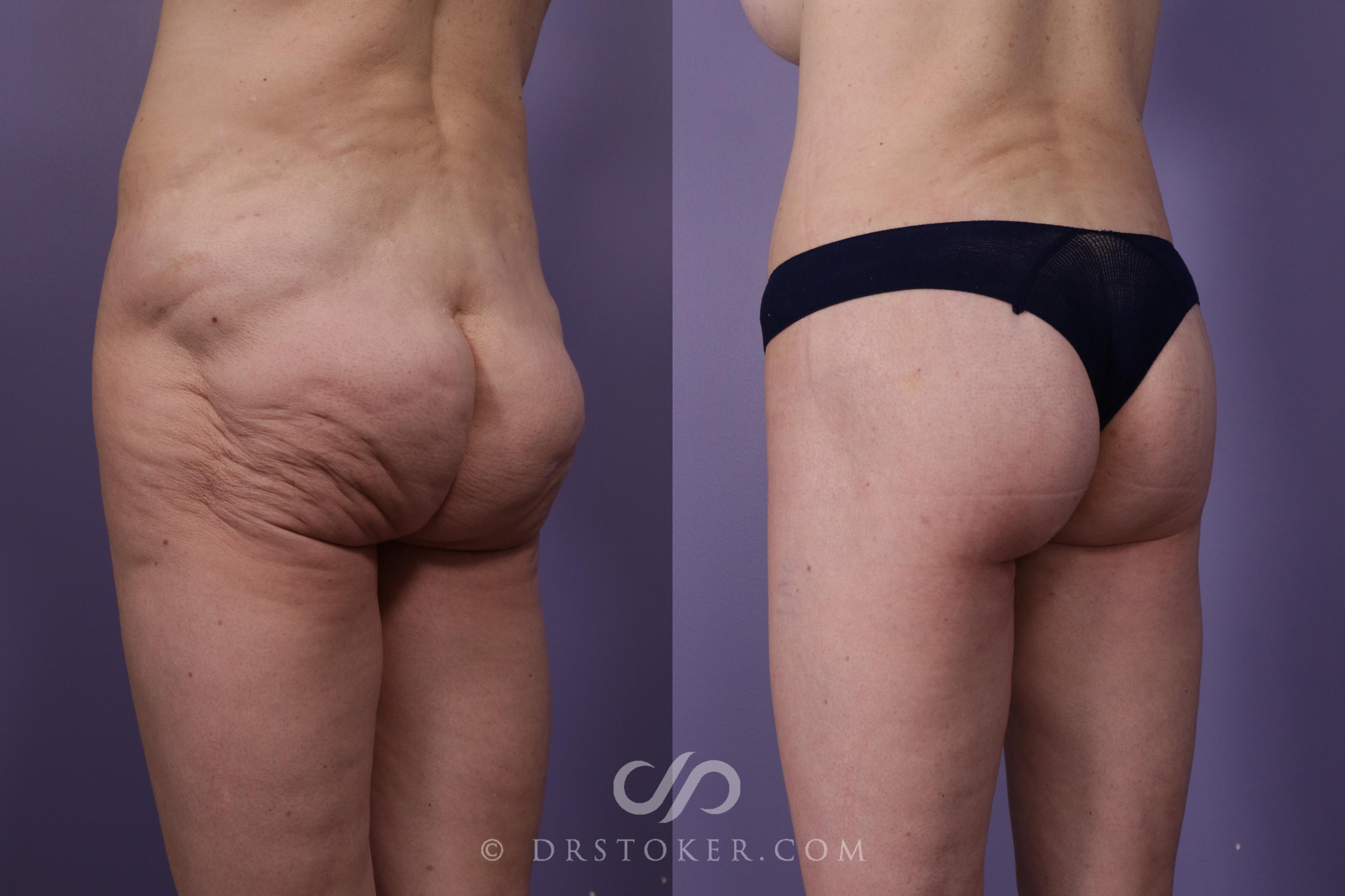 Before & After Body Lift Case 1824 Left Oblique View in Los Angeles, CA