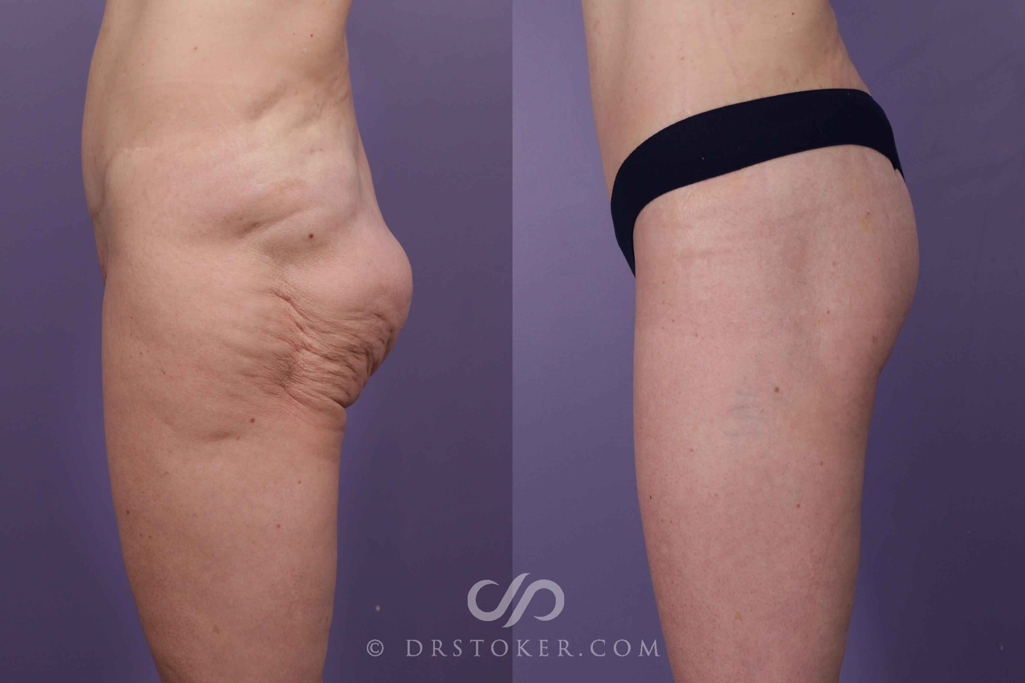 Before & After Body Lift Case 1825 Left Side View in Los Angeles, CA