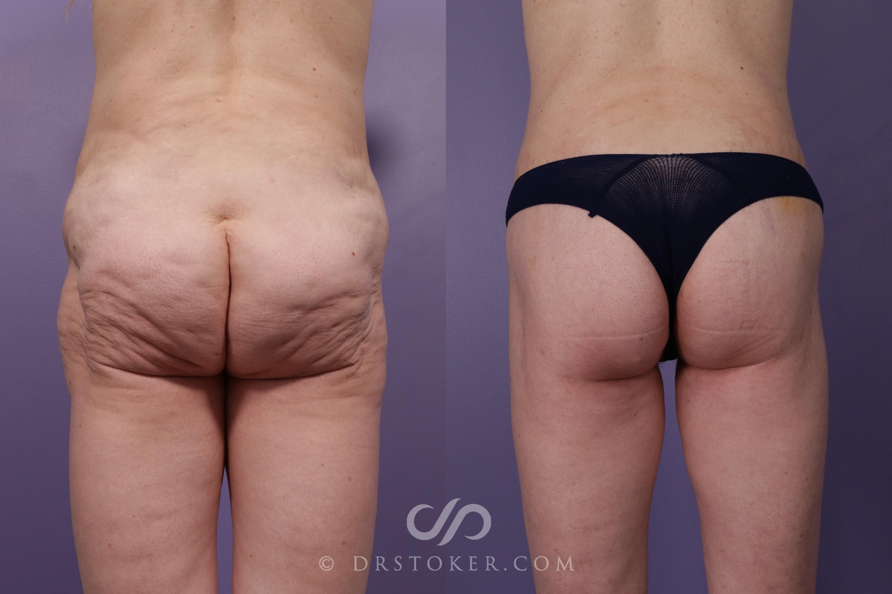 Before & After Body Lift Case 1826 Back View in Los Angeles, CA