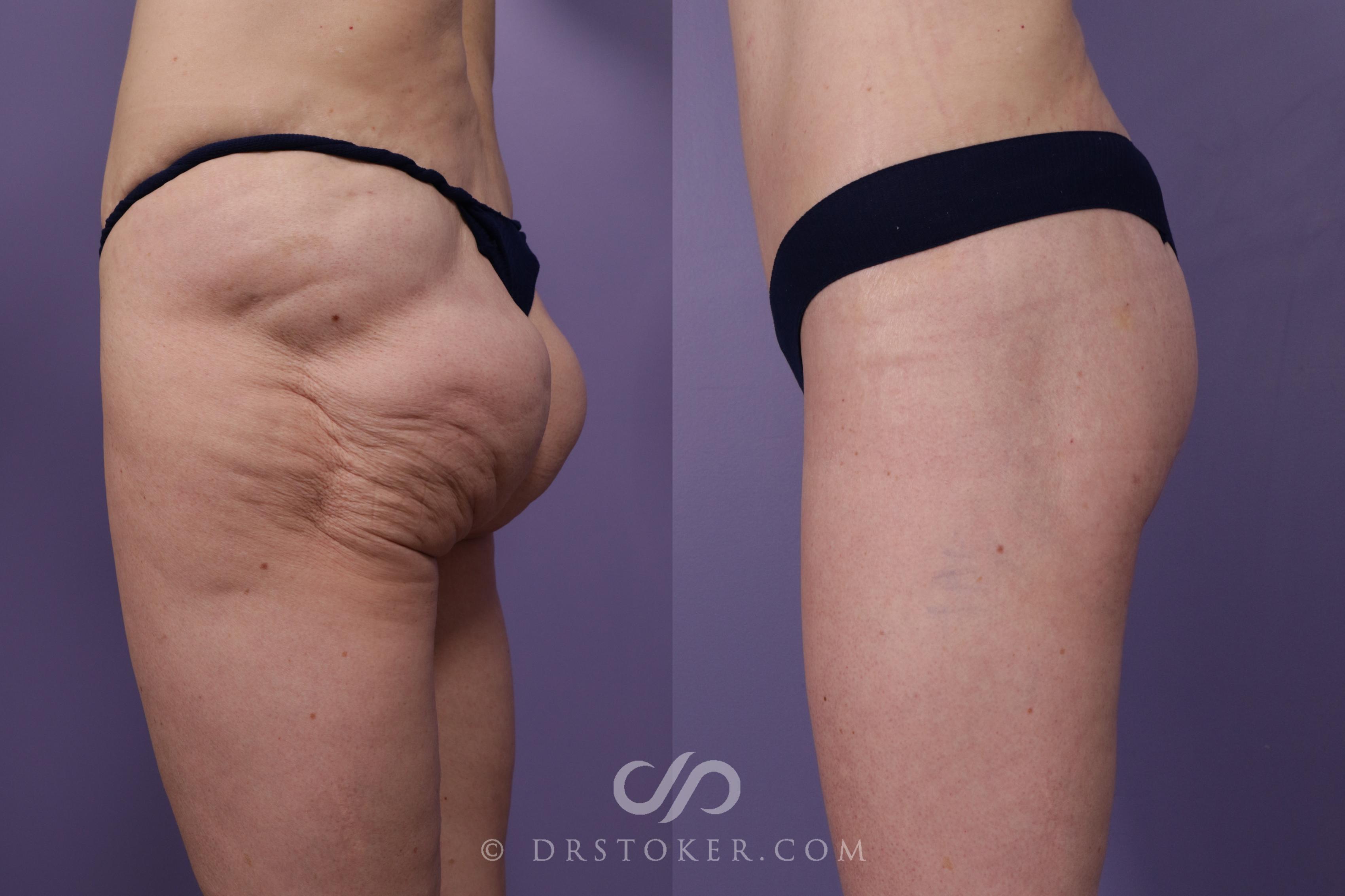 Before & After Body Lift Case 1827 Left Side View in Los Angeles, CA