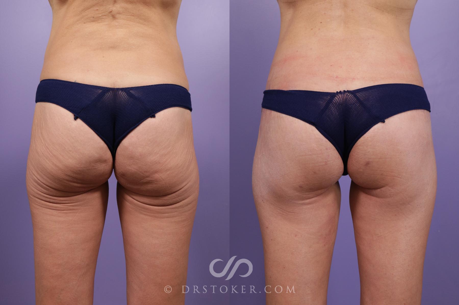Before & After Body Lift Case 1833 Back View in Los Angeles, CA