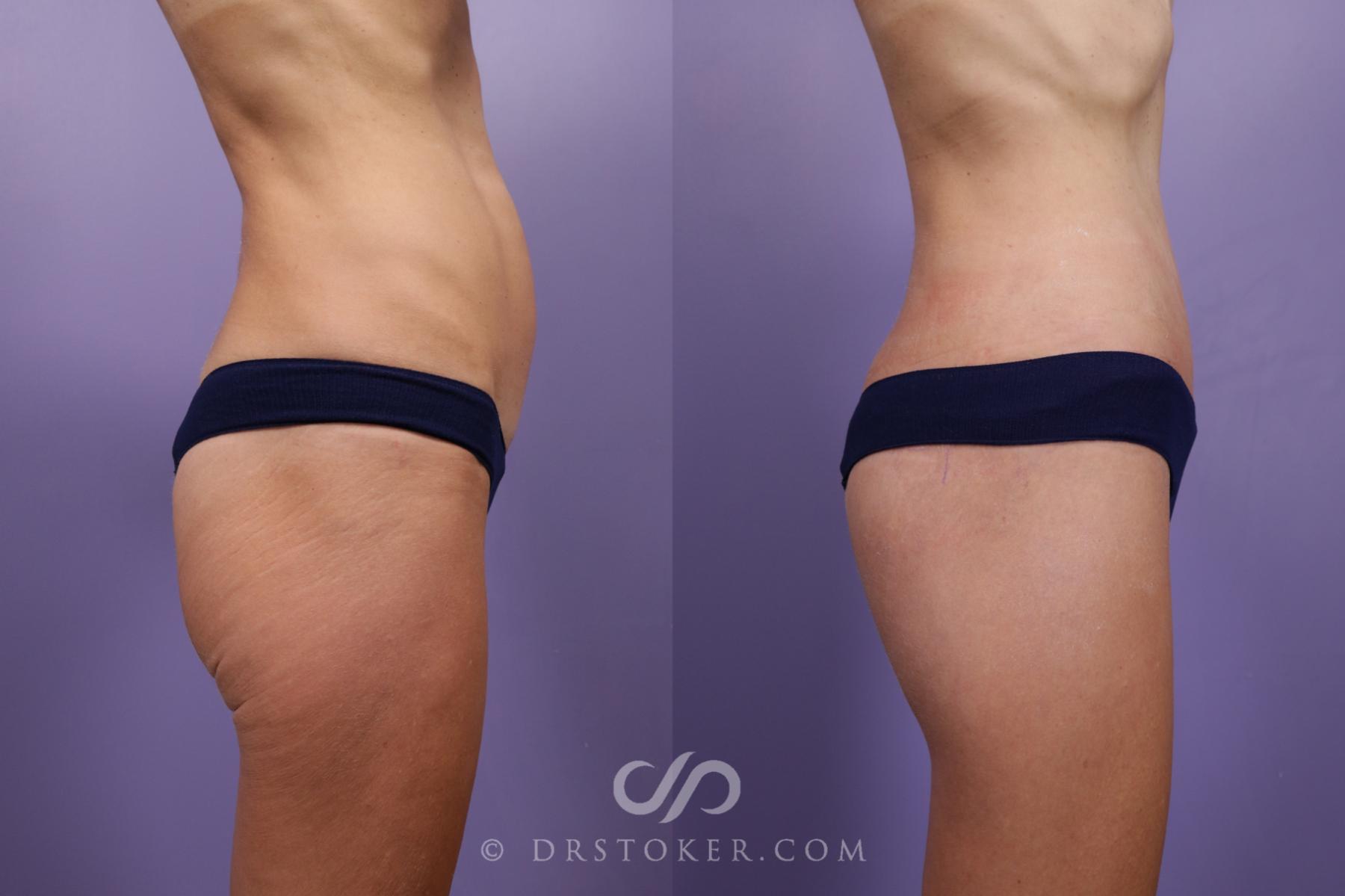 Before & After Body Lift Case 1833 Right Side View in Los Angeles, CA