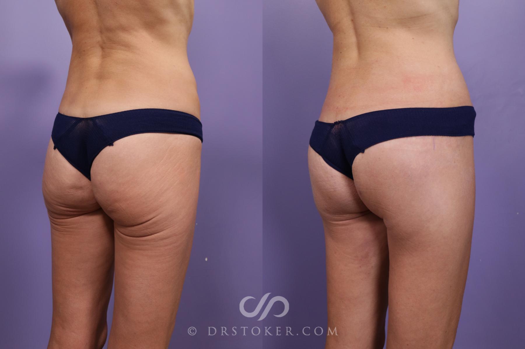 Before & After Body Lift Case 1834 Right Oblique View in Los Angeles, CA