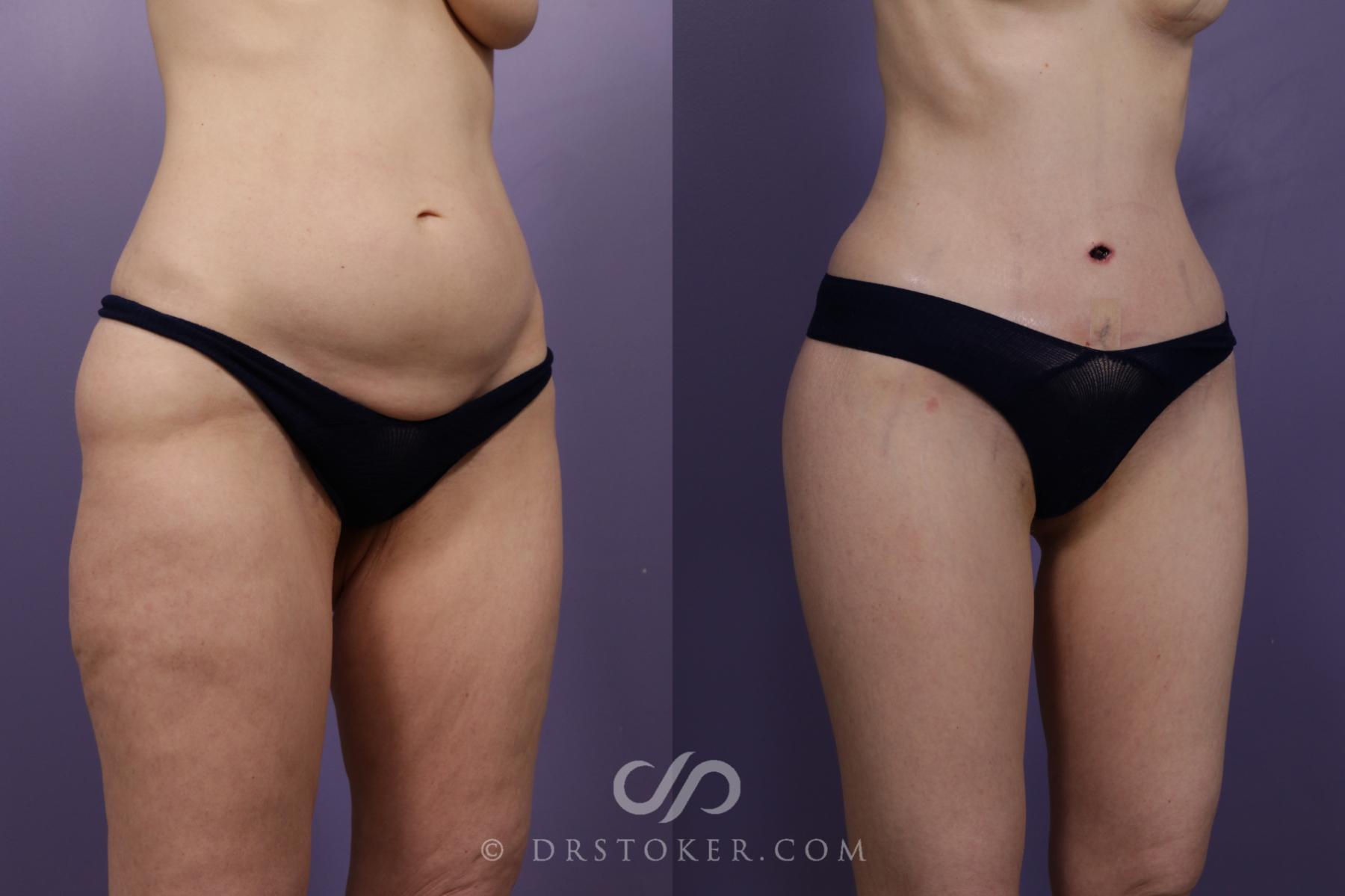 Before & After Body Lift Case 1837 Right Oblique View in Los Angeles, CA