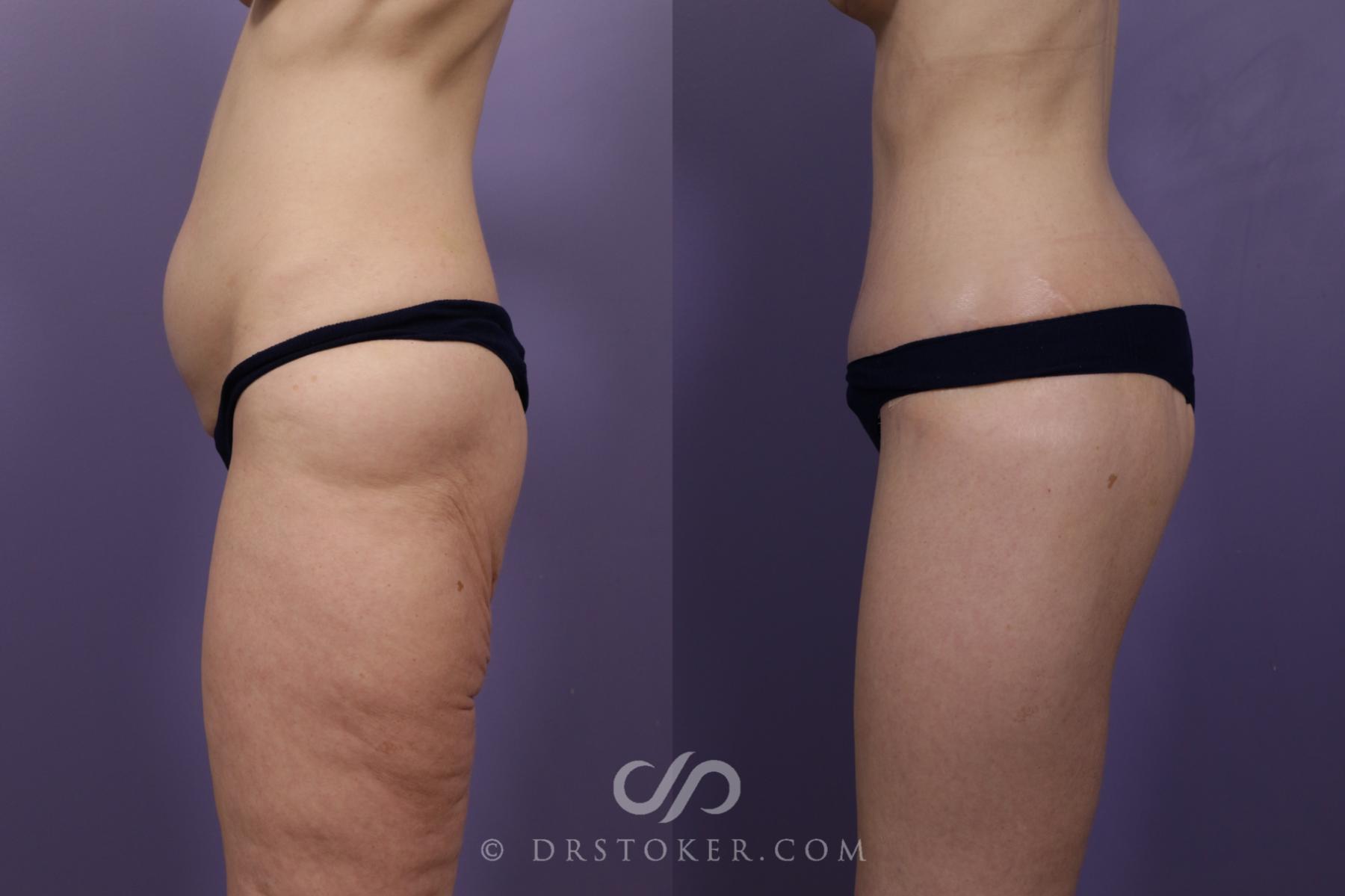 Before & After Body Lift Case 1838 Left Side View in Los Angeles, CA