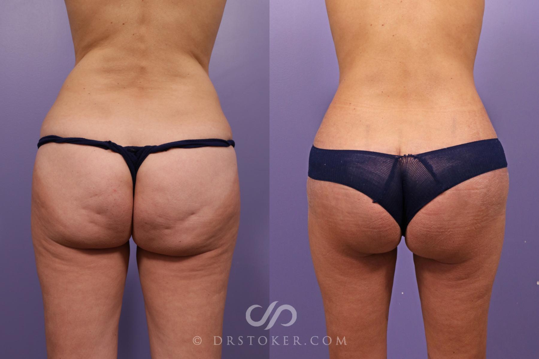 Before & After Body Lift Case 1840 Back View in Los Angeles, CA