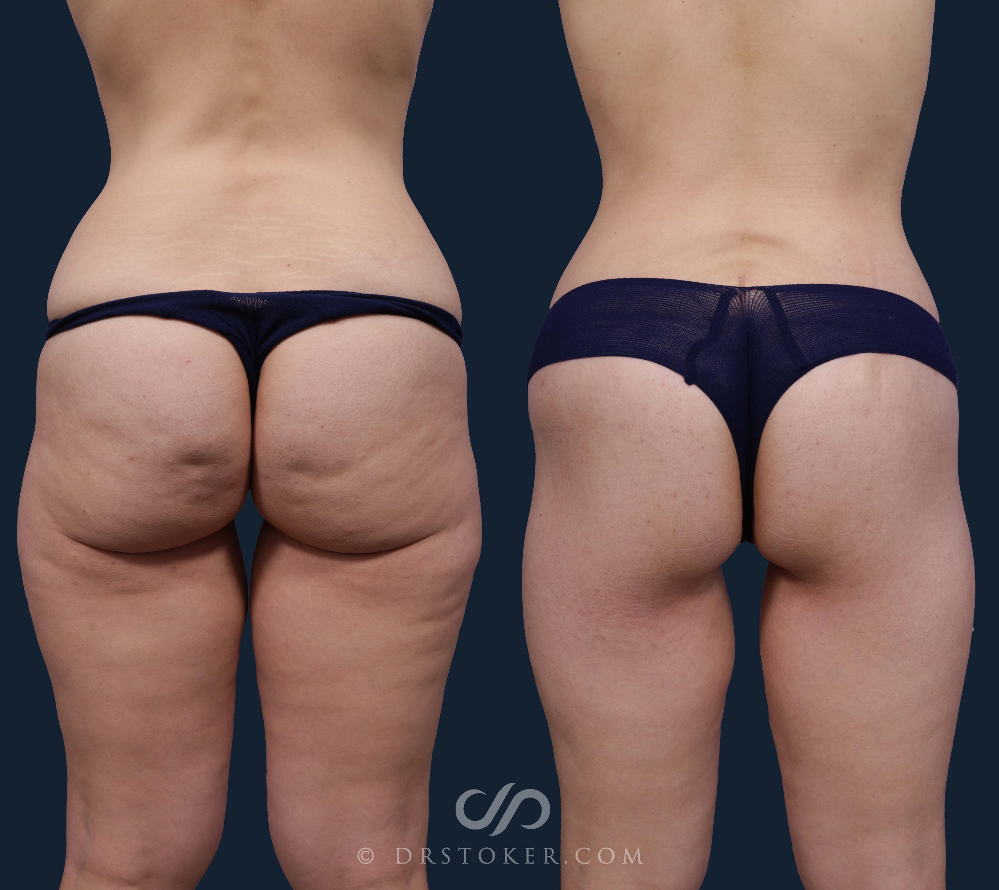 Before & After Body Lift Case 1918 Back View in Los Angeles, CA