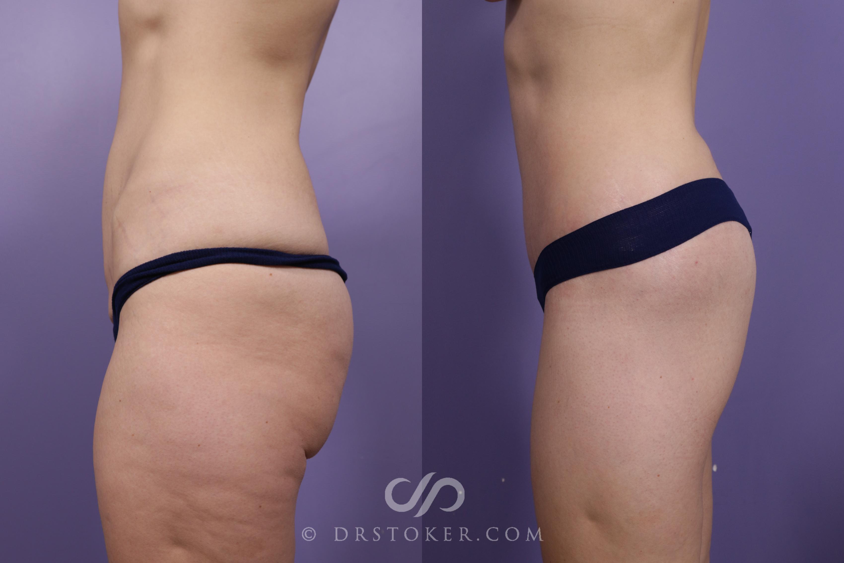 Before & After Bikini Body Lift Case 1918 Left Side View in Los Angeles, CA