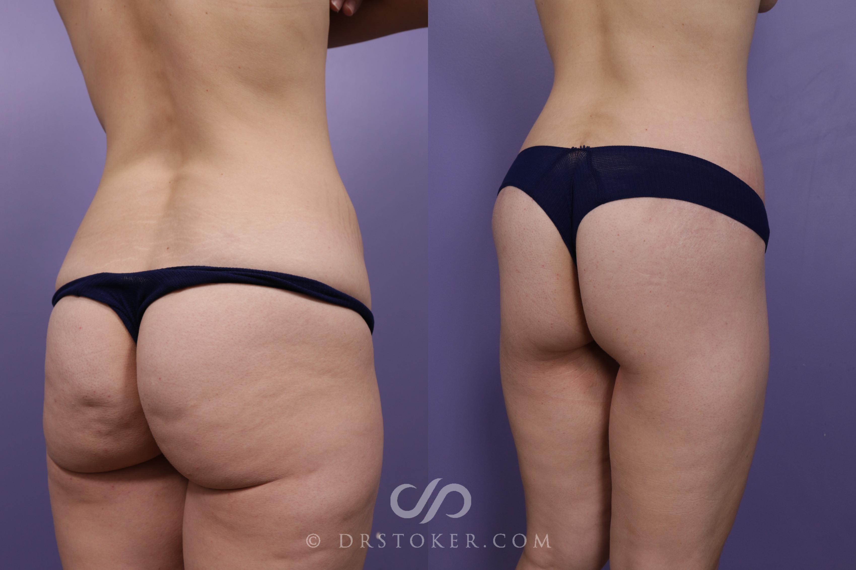 Before & After Bikini Body Lift Case 1918 Right Oblique View in Los Angeles, CA