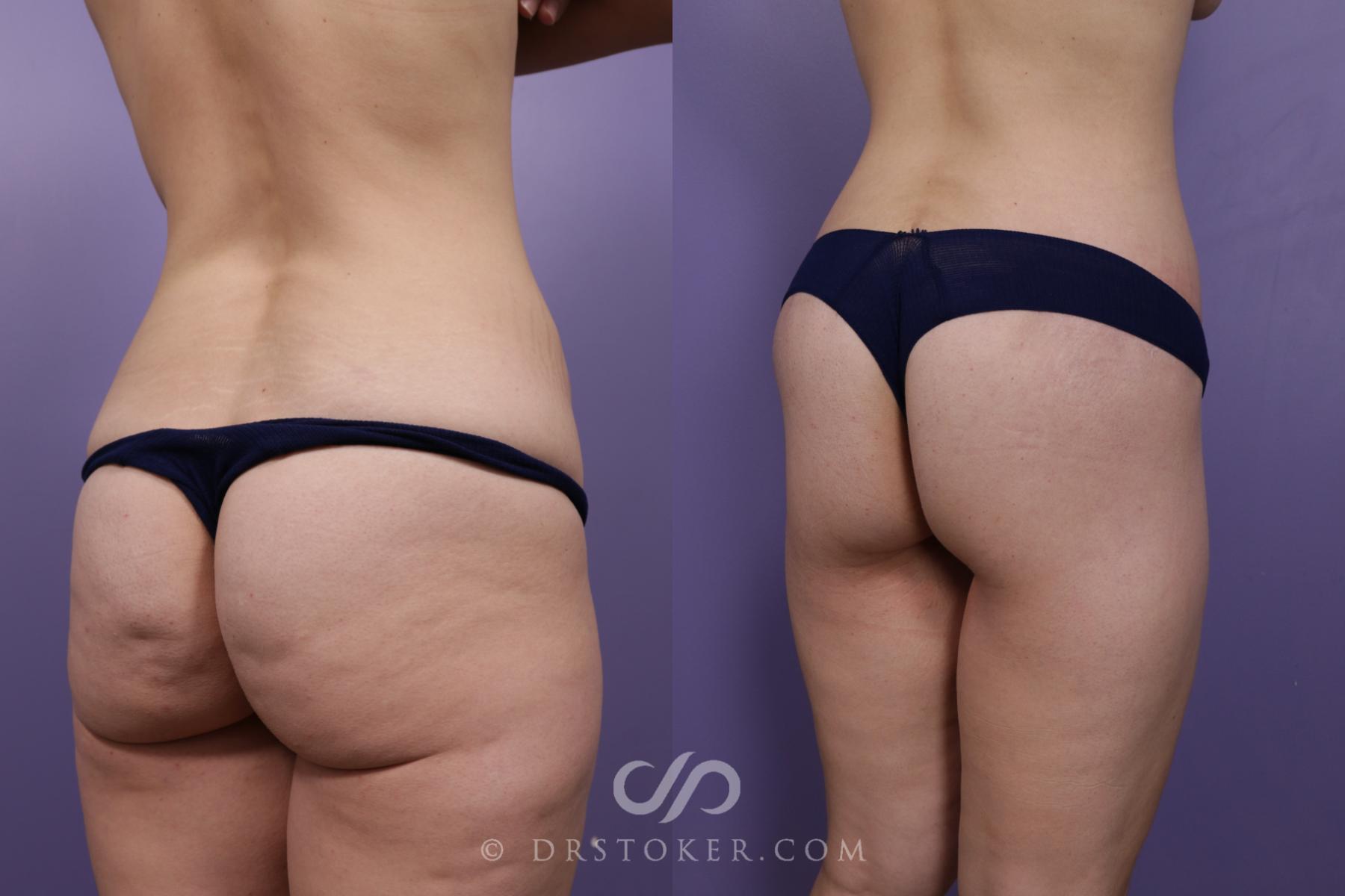Before & After Bikini Body Lift Case 1918 Right Oblique View in Los Angeles, CA