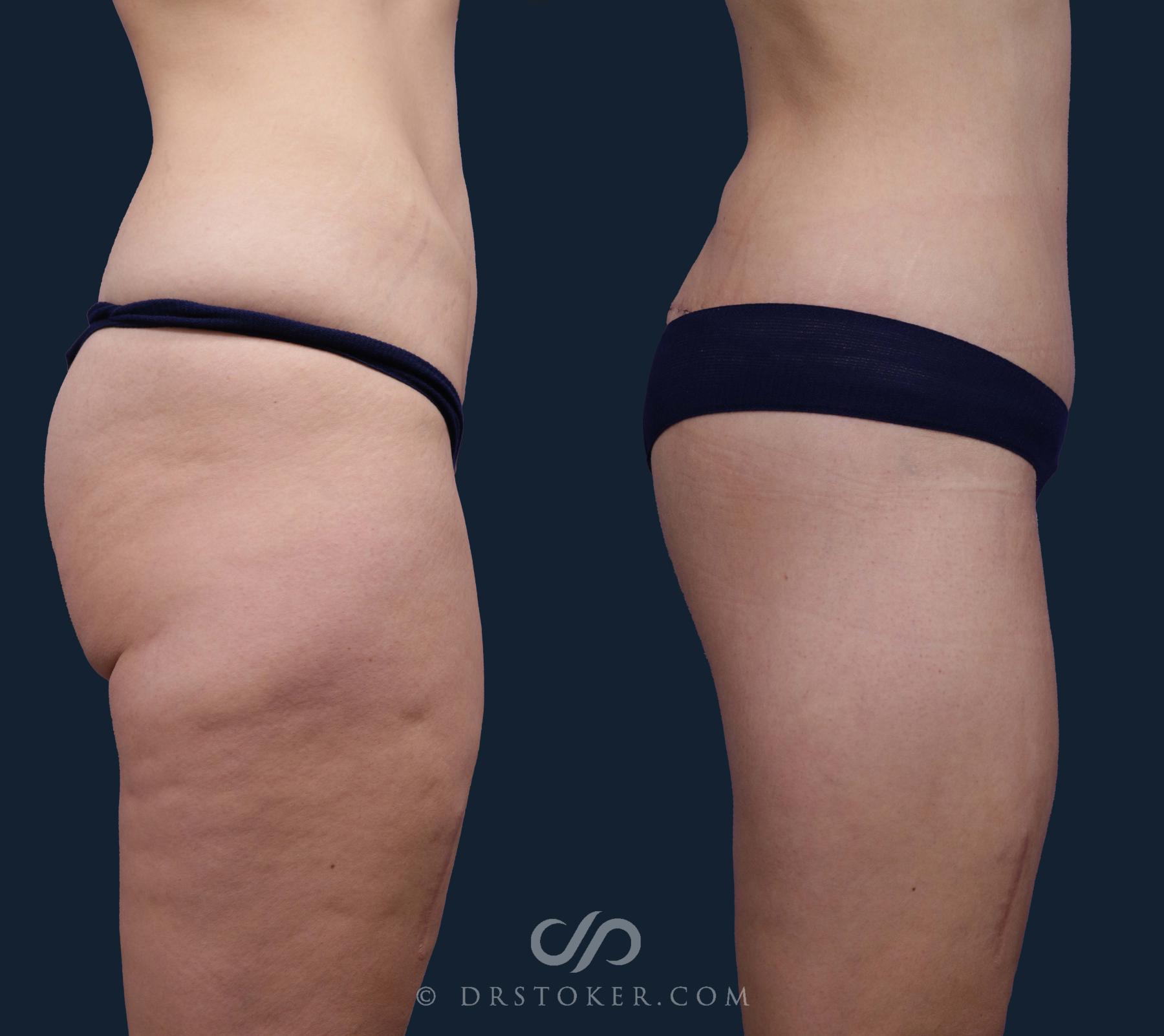 Before & After Body Lift Case 1919 Right Side View in Los Angeles, CA