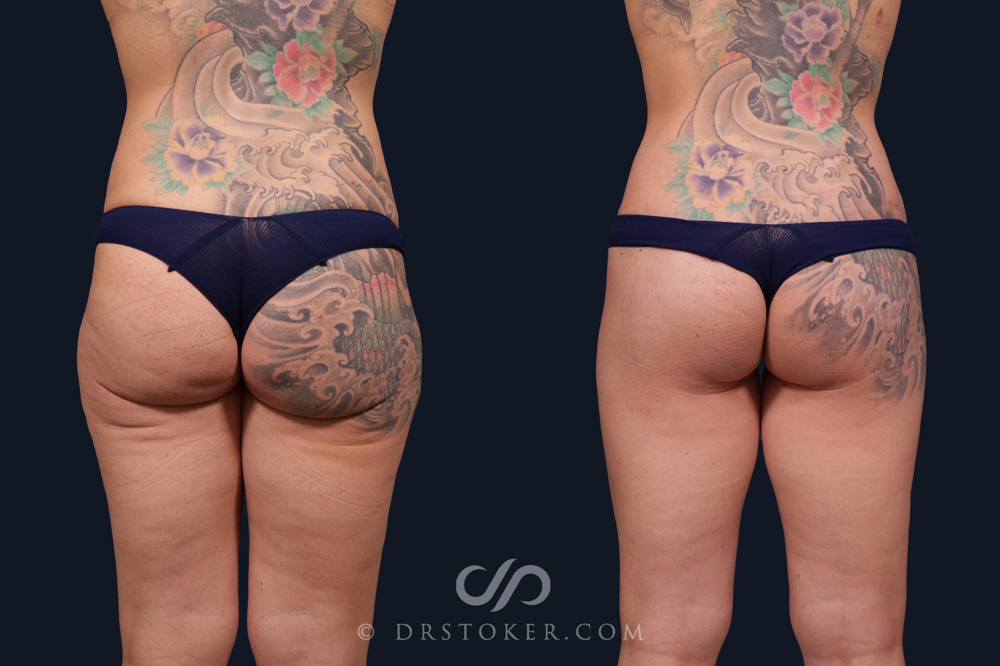 Before & After Body Lift Case 2059 Back View in Los Angeles, CA