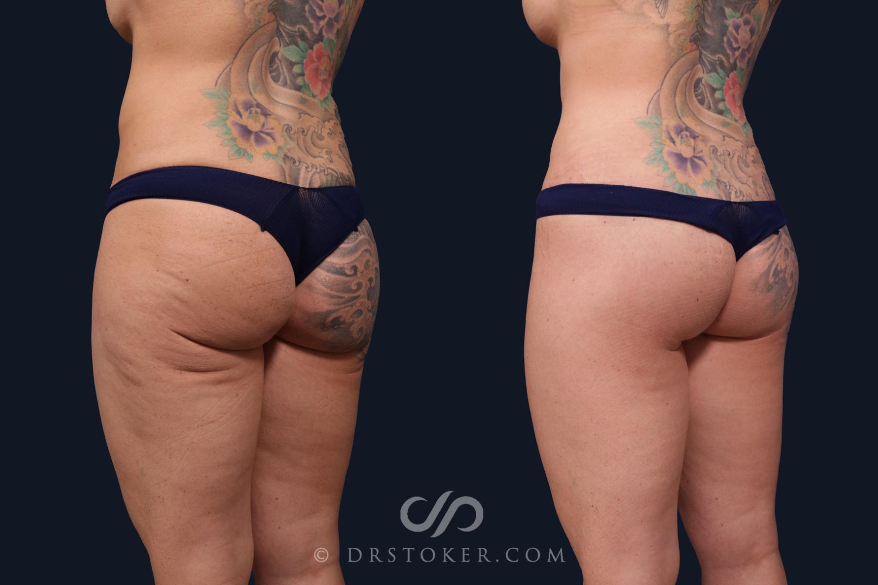 Before & After Body Lift Case 2059 Left Oblique View in Los Angeles, CA