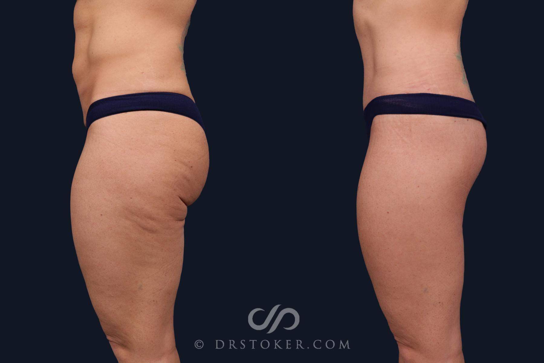 Before & After Body Lift Case 2059 Left Side View in Los Angeles, CA