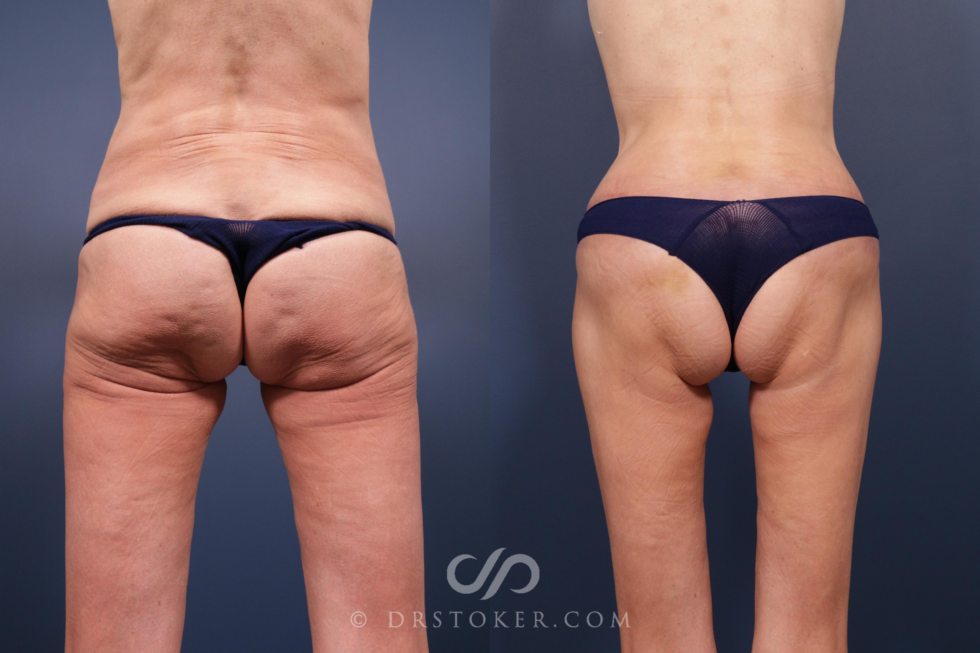 Before & After Body Lift Case 2072 Back View in Los Angeles, CA