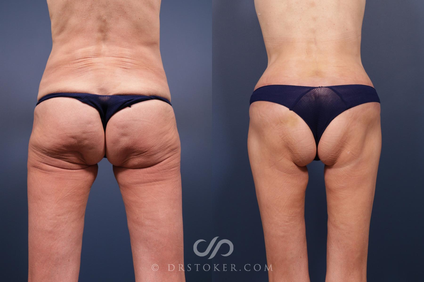 Before & After Body Lift Case 2072 Back View in Los Angeles, CA