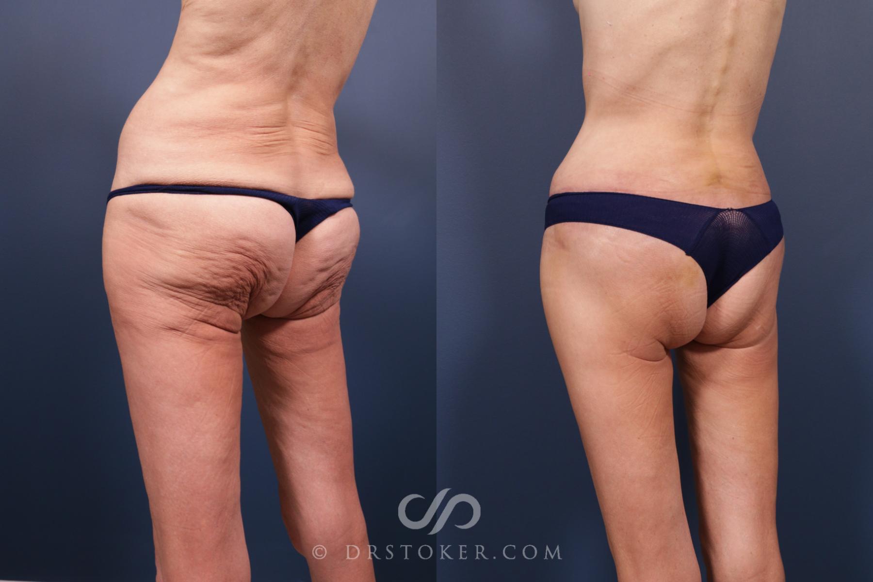 Before & After Body Lift Case 2072 Left Oblique View in Los Angeles, CA