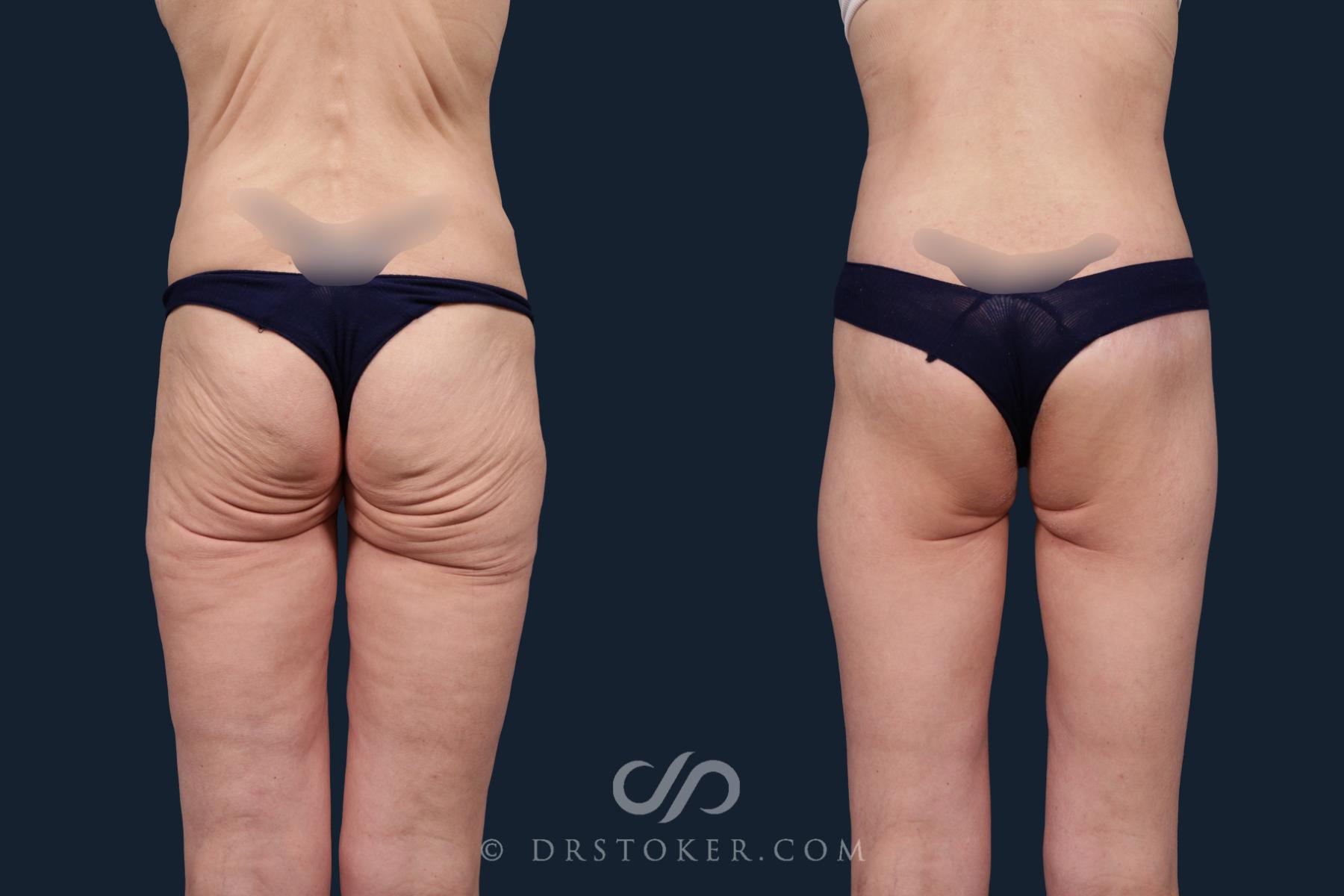 Before & After Body Lift Case 2135 Back View in Los Angeles, CA
