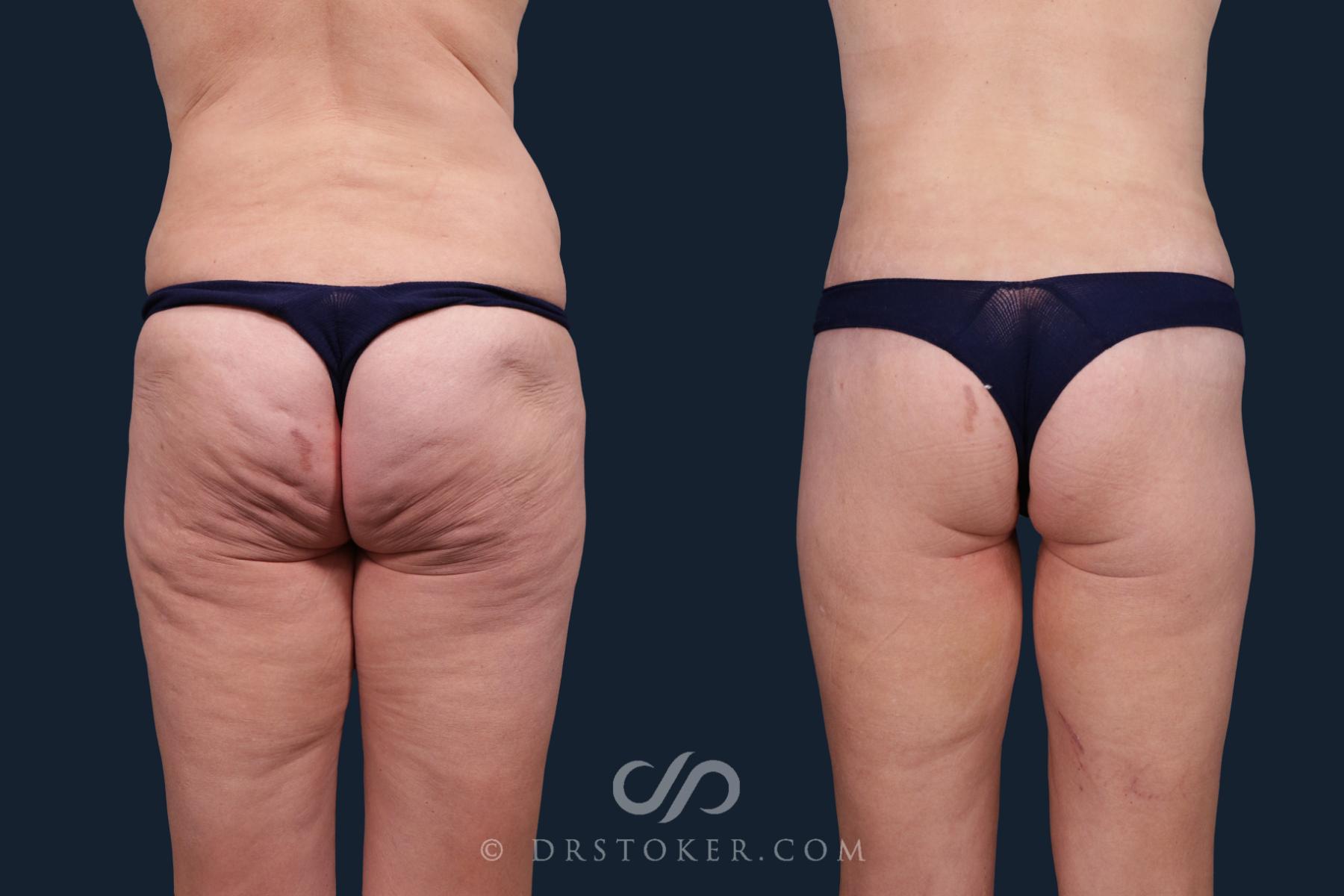 Before & After Body Lift Case 2167 Back View in Los Angeles, CA