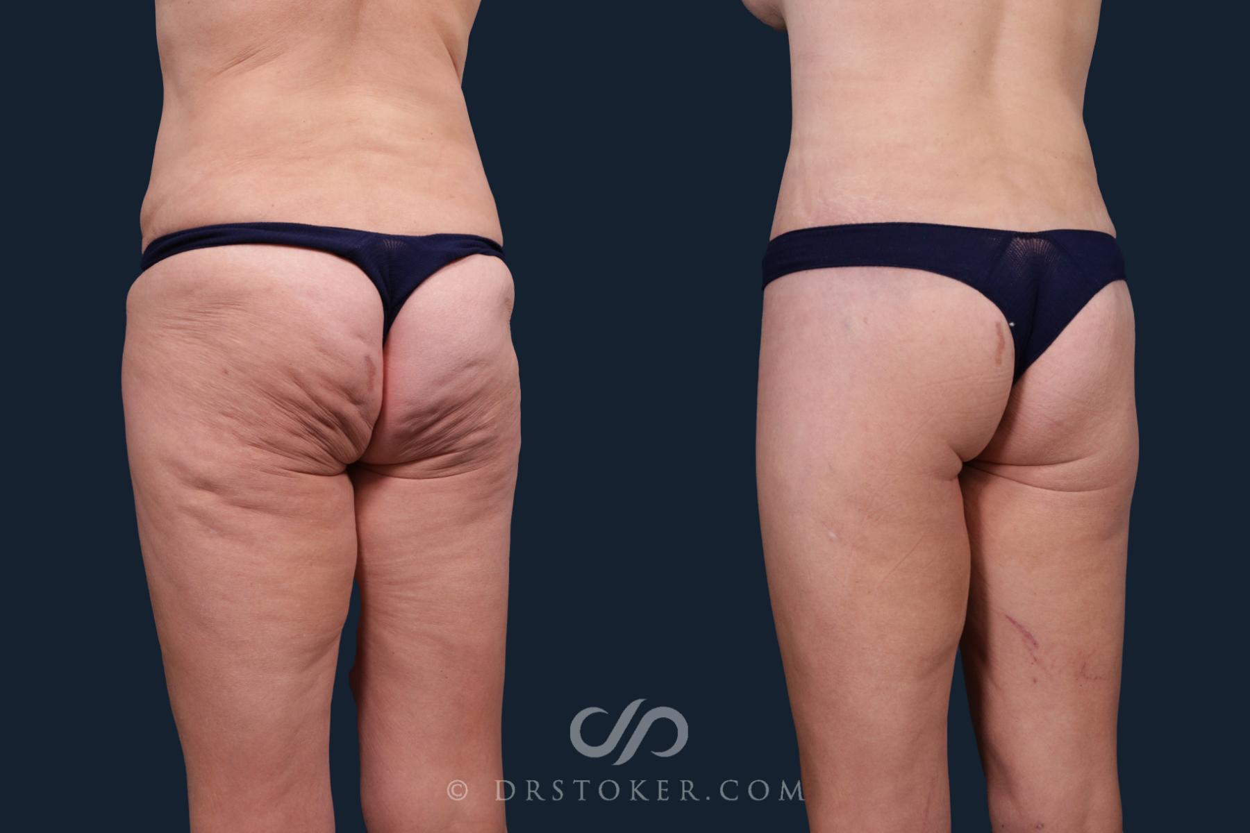 Before & After Body Lift Case 2167 Left Oblique View in Los Angeles, CA