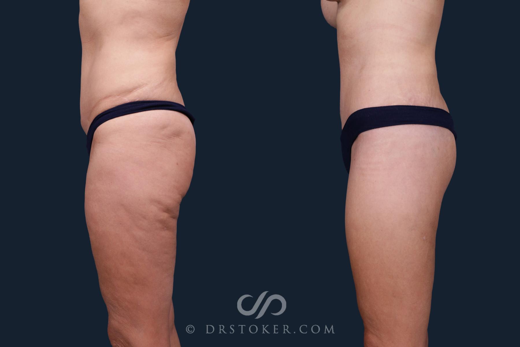 Before & After Body Lift Case 2167 Left Side View in Los Angeles, CA