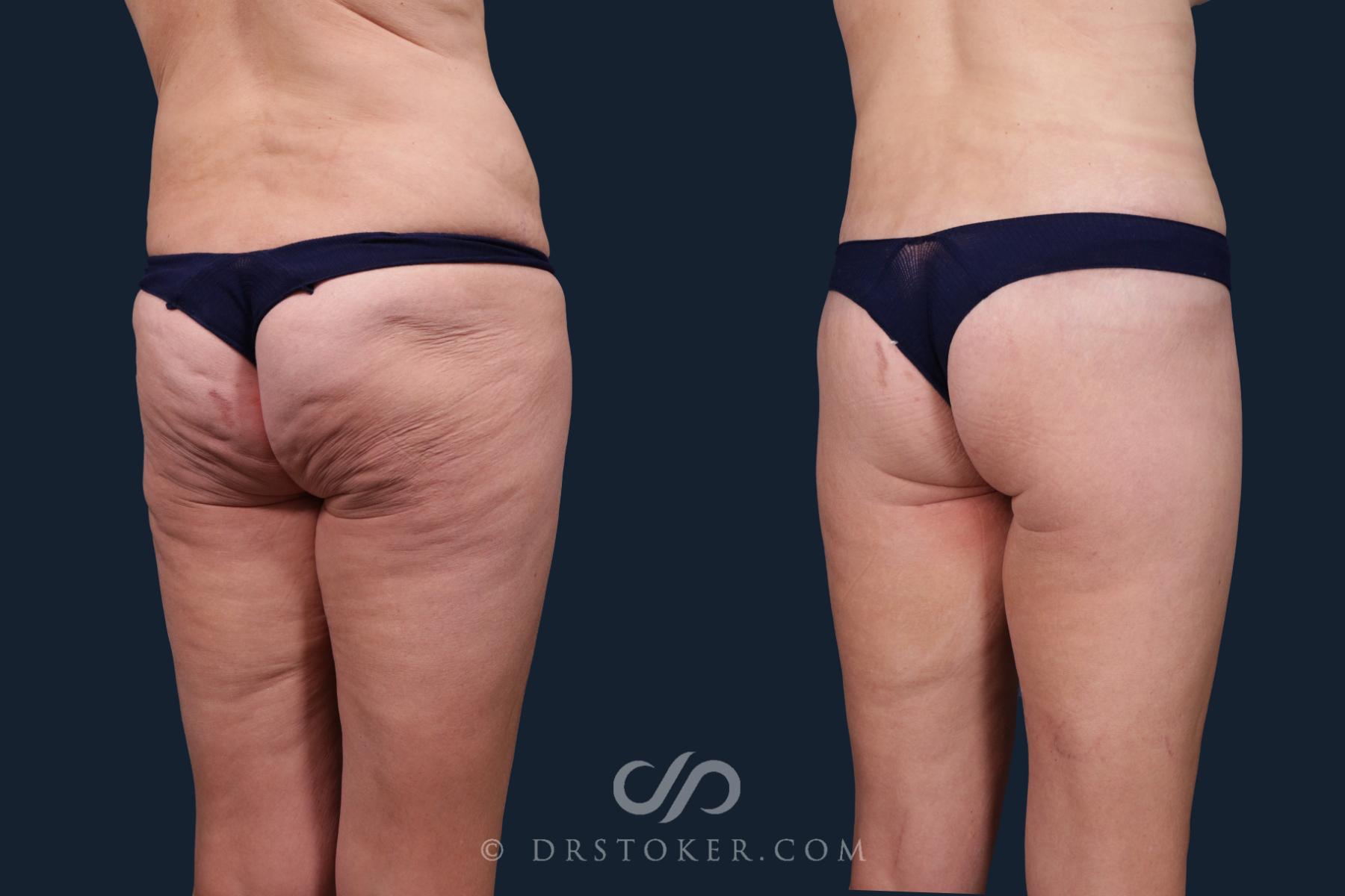 Before & After Body Lift Case 2167 Right Oblique View in Los Angeles, CA