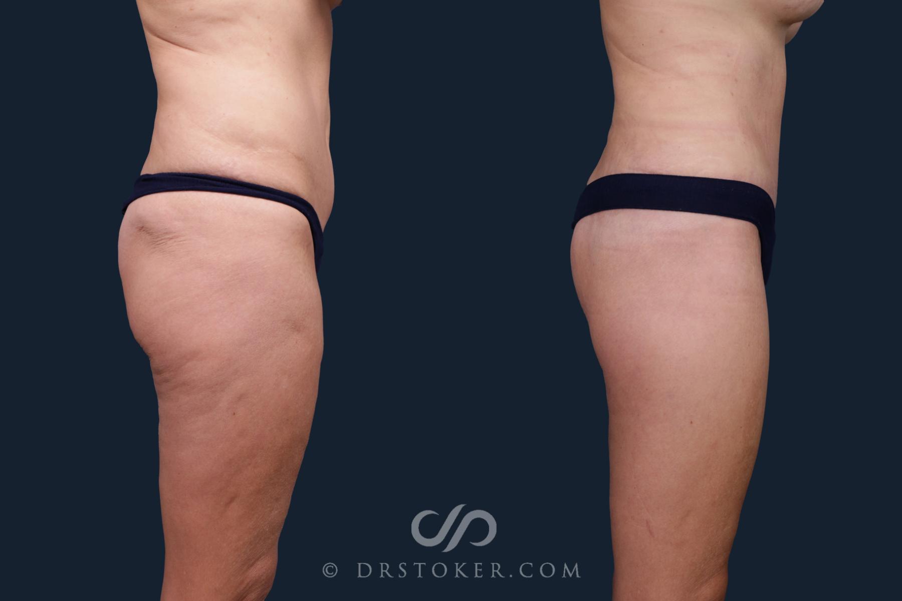 Before & After Body Lift Case 2167 Right Side View in Los Angeles, CA