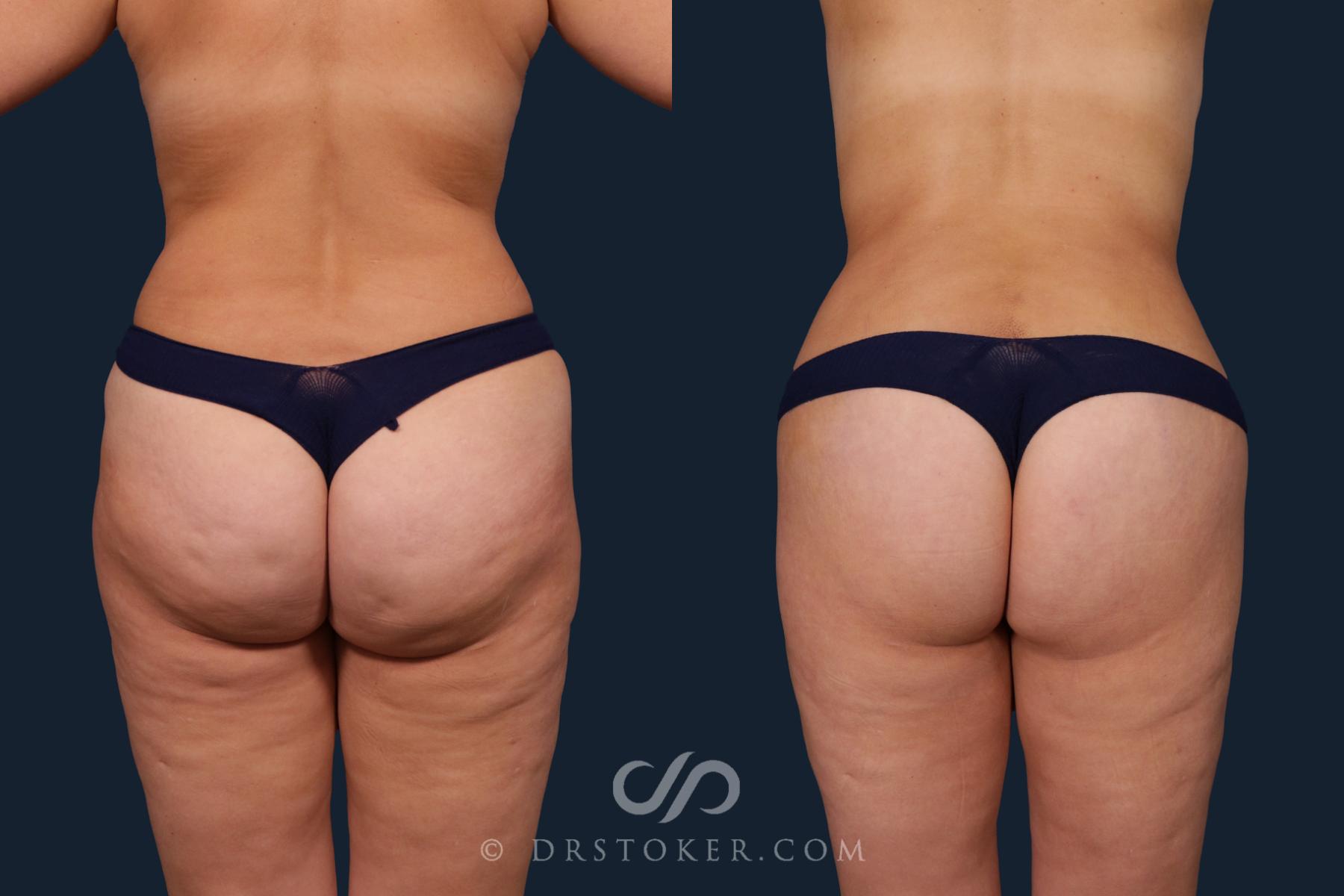 Before & After Body Lift Case 2184 Back View in Los Angeles, CA