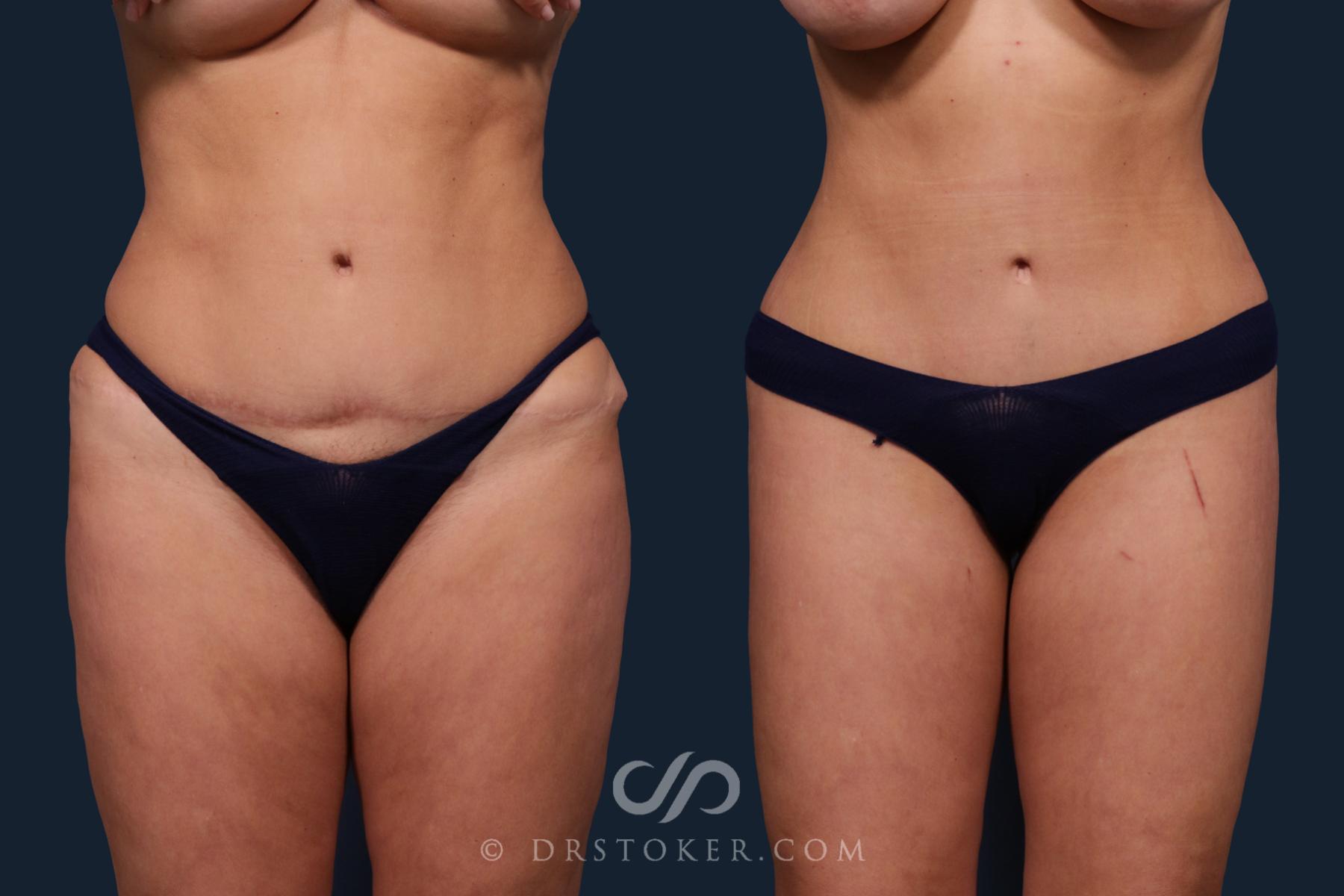 Before & After Body Lift Case 2184 Front View in Los Angeles, CA