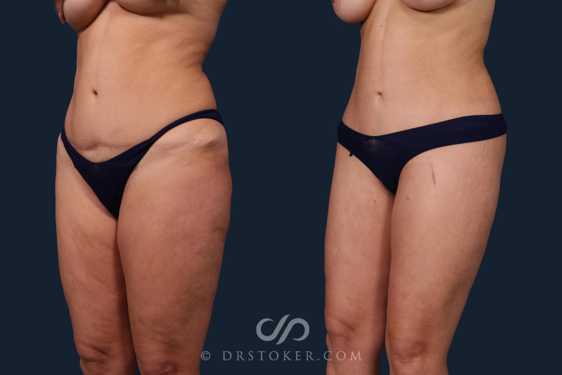 Before & After Body Lift Case 2184 Left Oblique View in Los Angeles, CA
