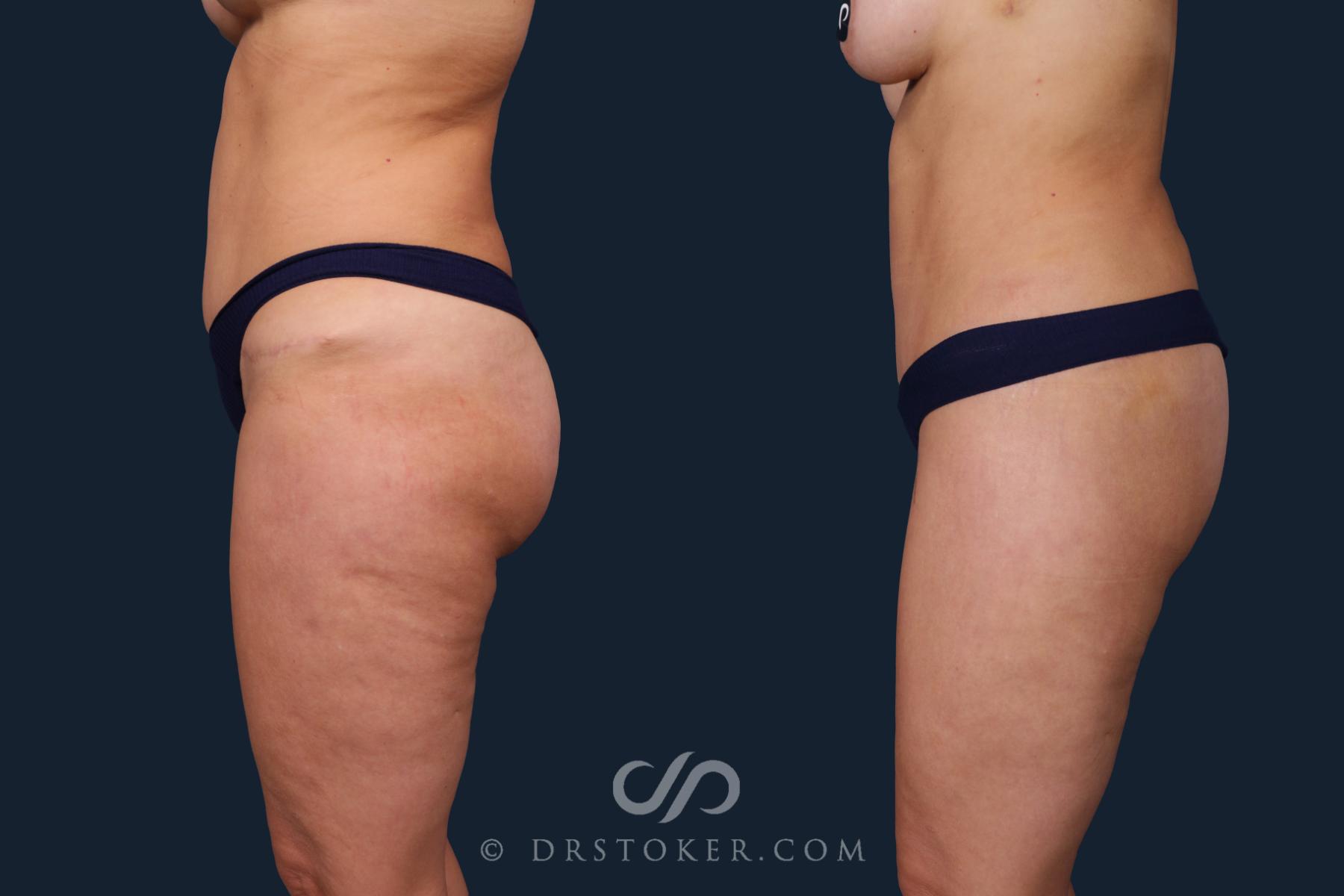 Before & After Body Lift Case 2184 Left Side View in Los Angeles, CA
