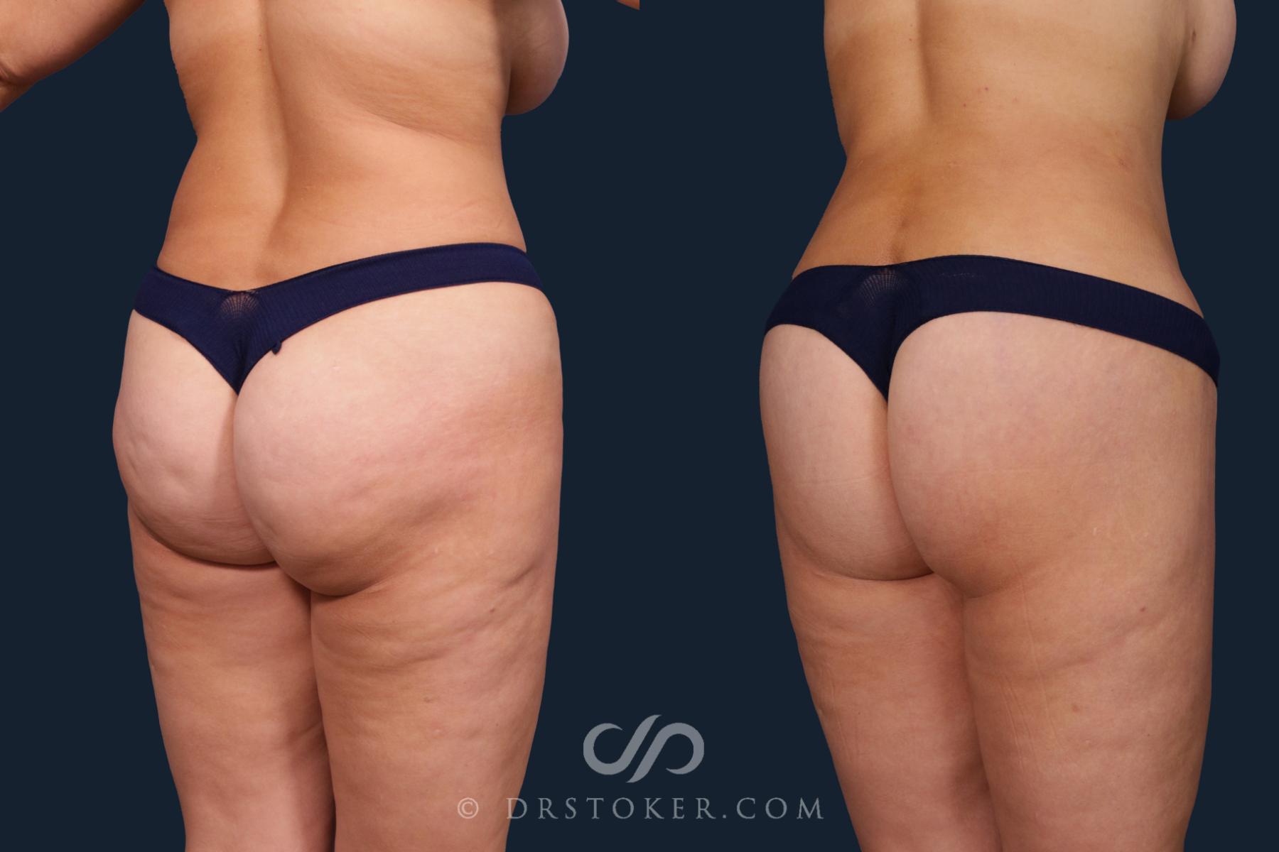 Before & After Body Lift Case 2184 Right Oblique View in Los Angeles, CA