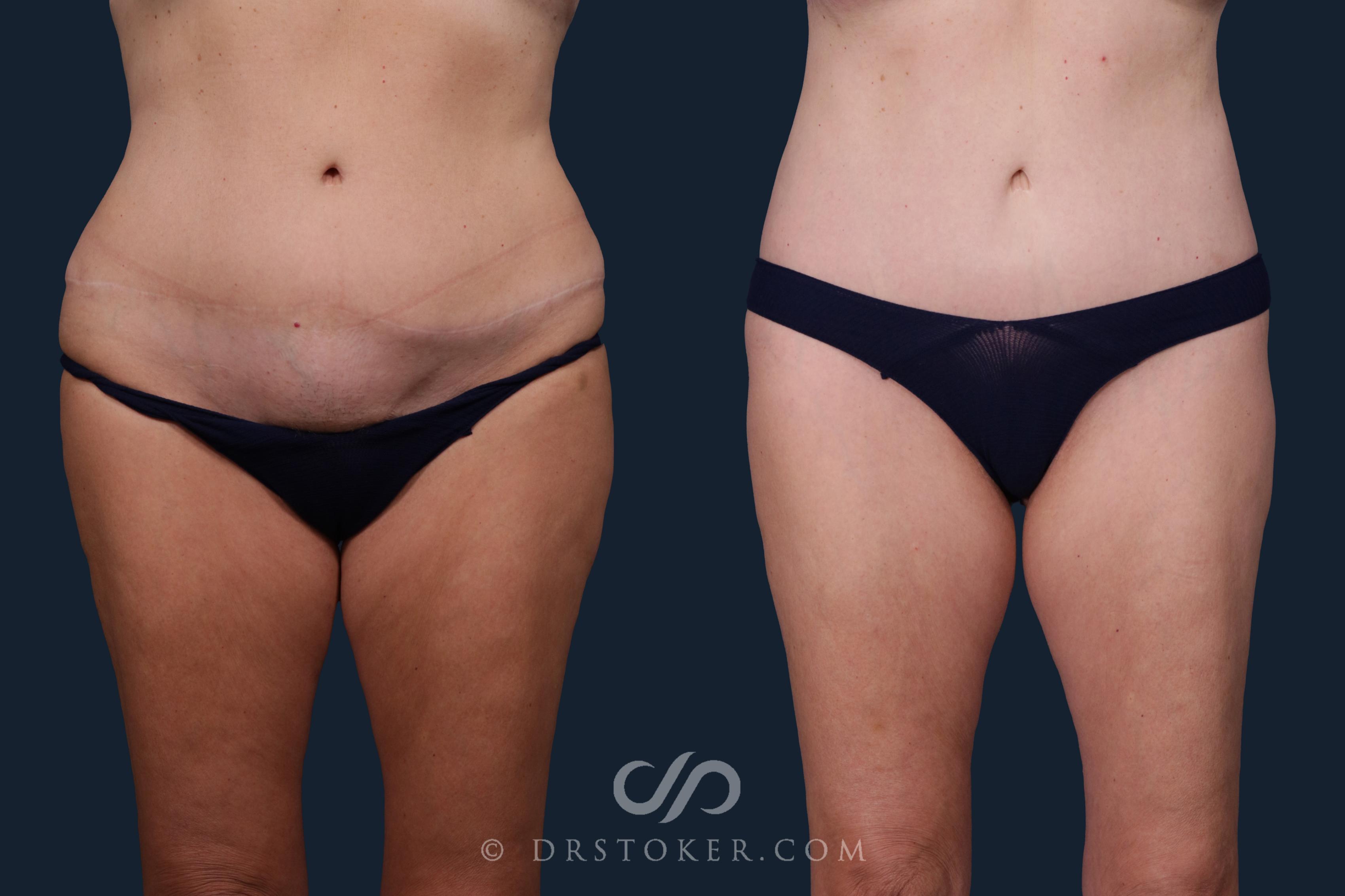 Before & After Tummy Tuck Case 2214 Front View in Los Angeles, CA